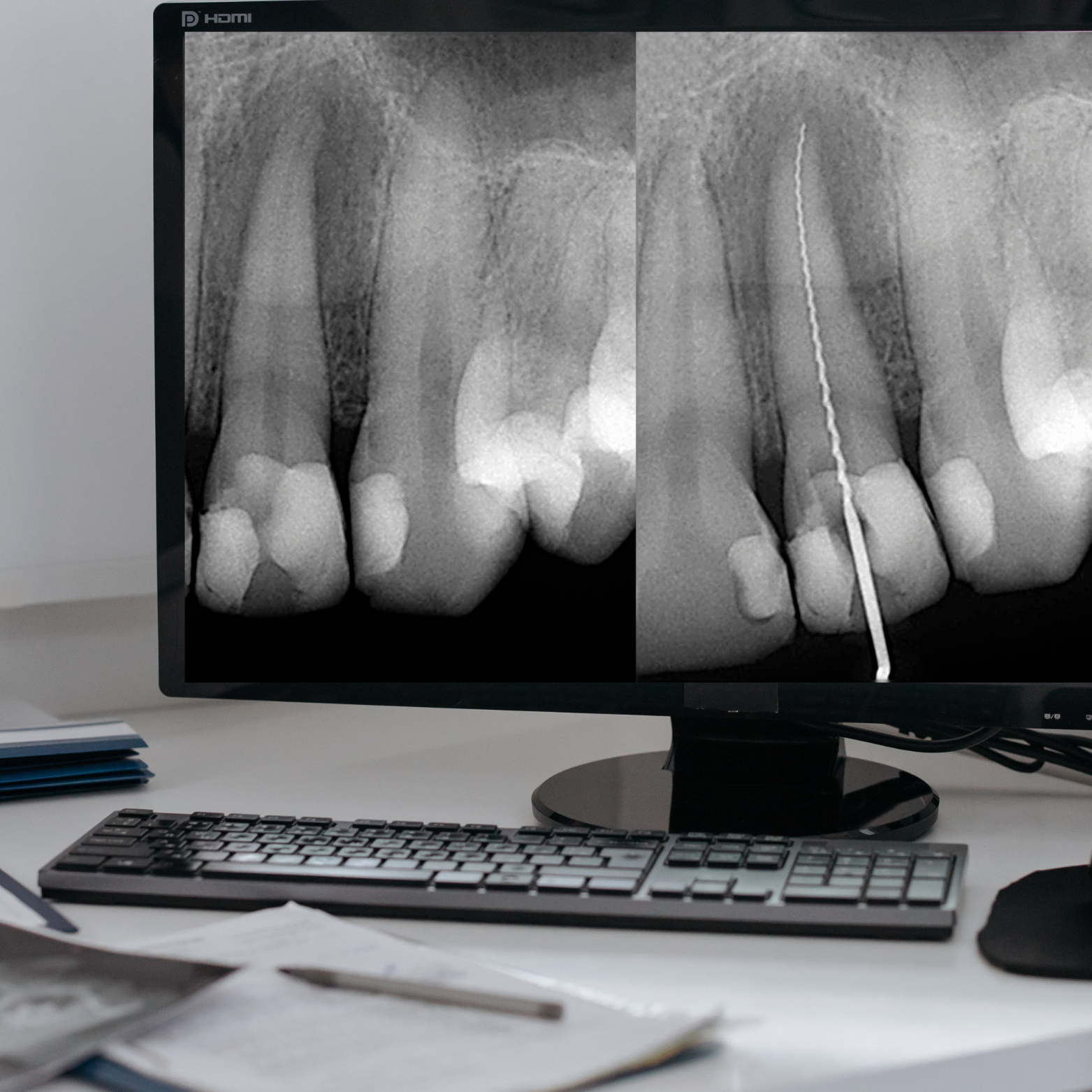 INTRAORAL X-RAY