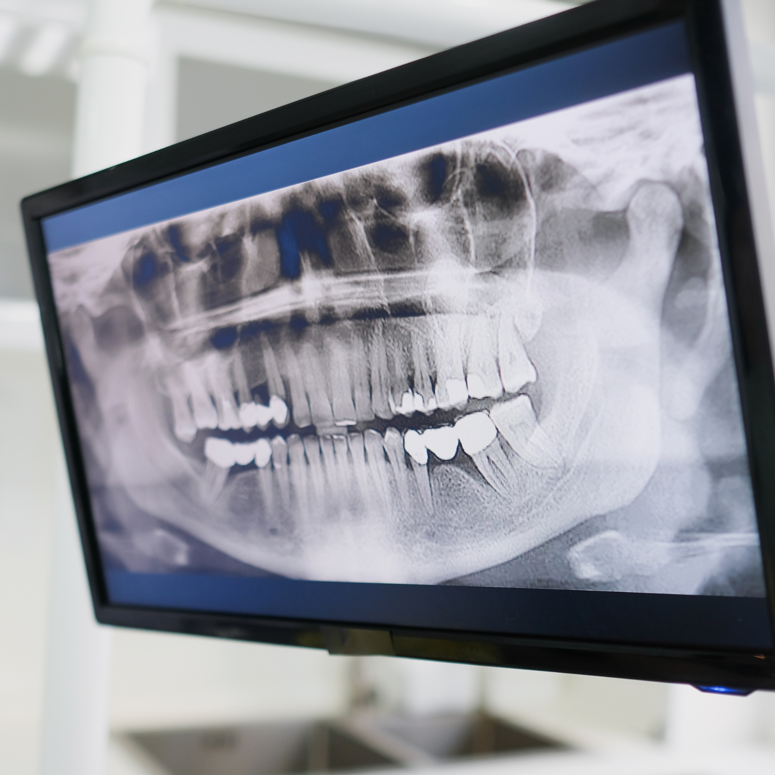 EXTRAORAL X-RAY