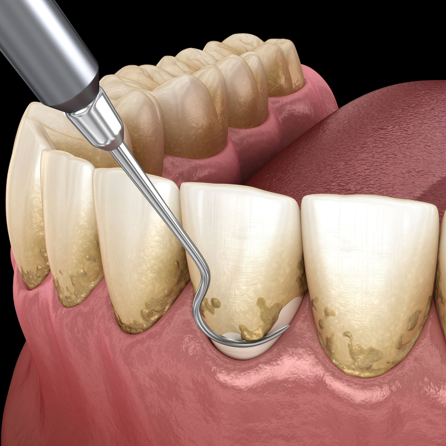 TOOTH CLEANING
