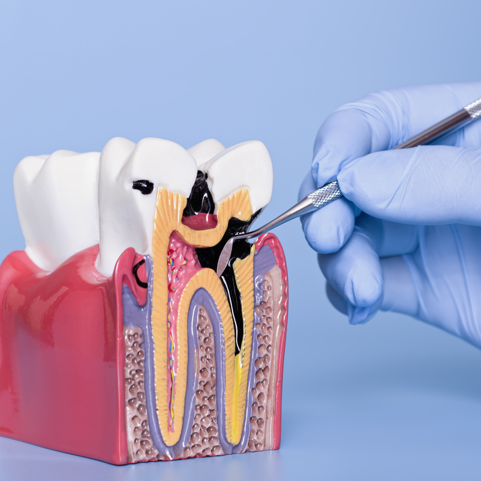 ROOT CANAL TREATMENT