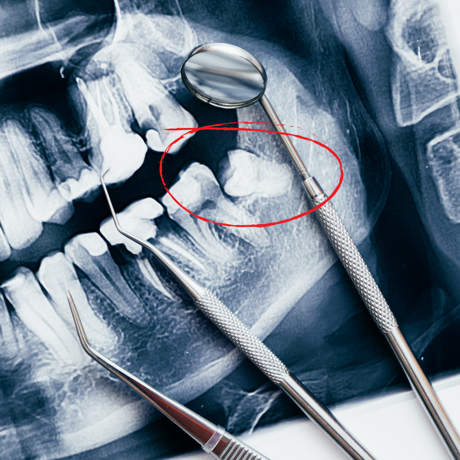 IMPACTED AND EMBEDDED SURGERY REMOVAL 