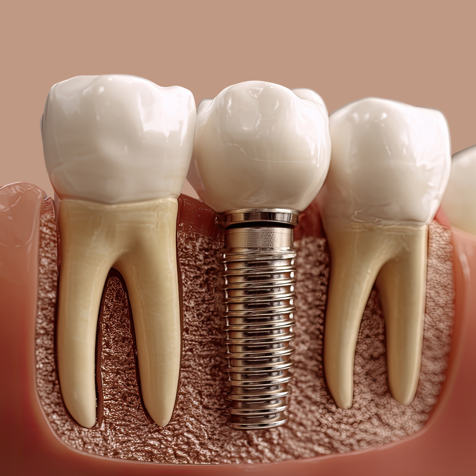 CROWN ON IMPLANT