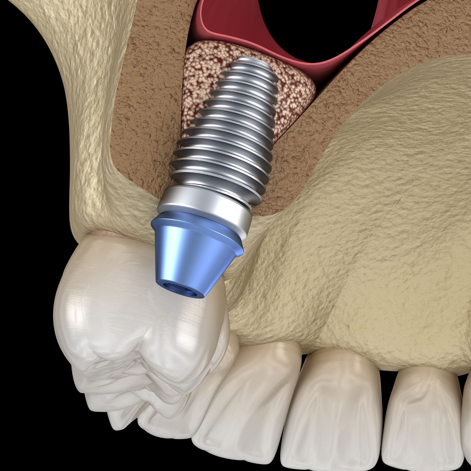 IMPLANT PLACEMENT