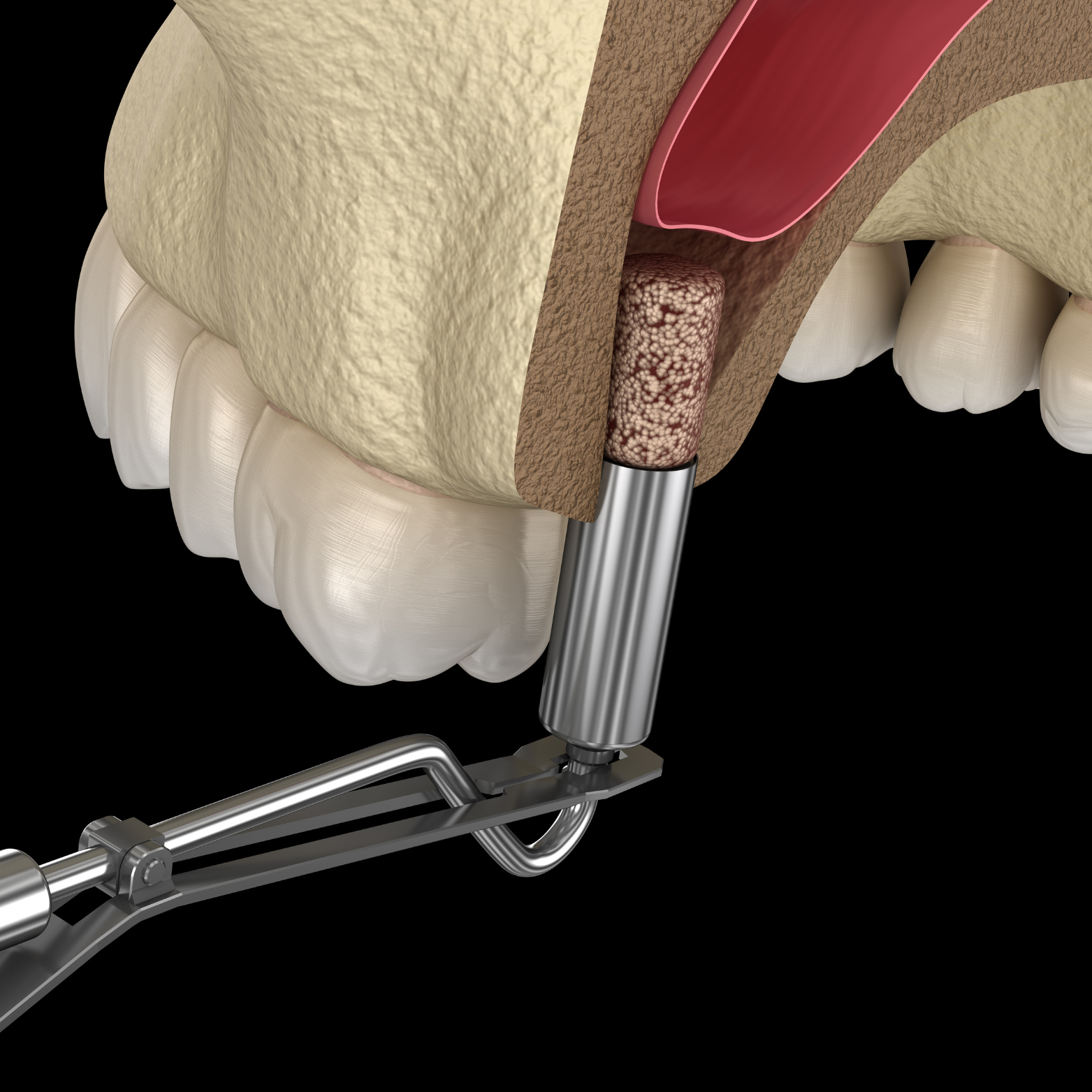 BONE AUGMENTATION