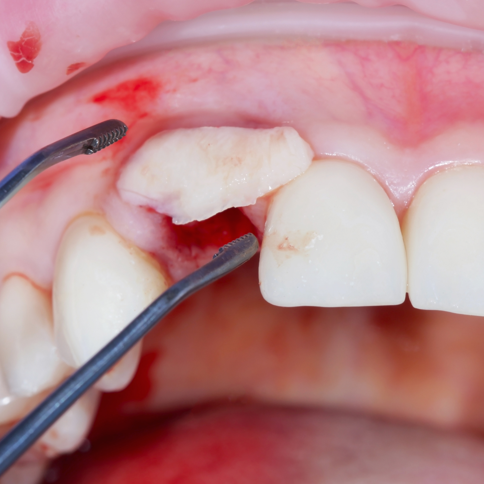 GUM AUGMENTATION