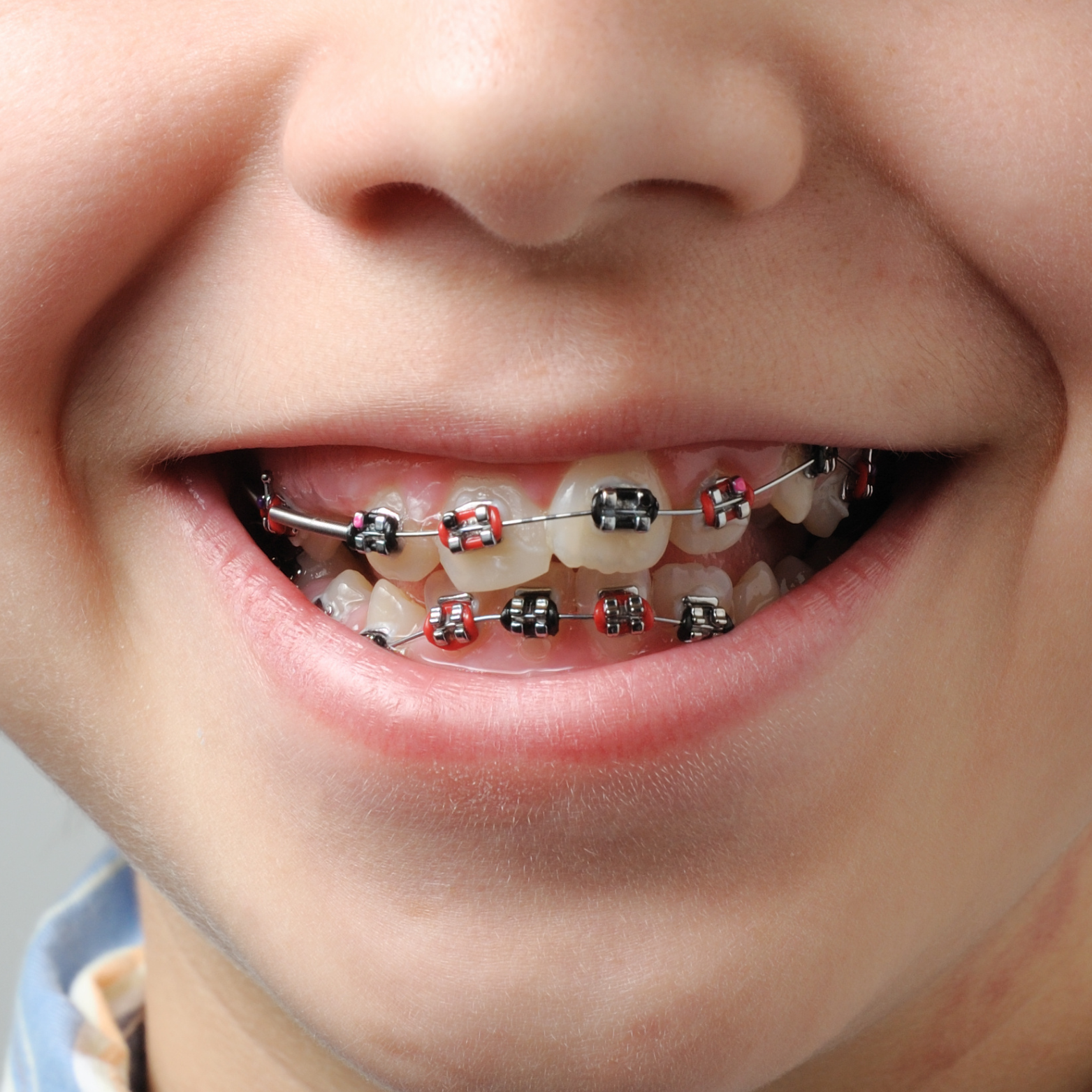 INTERCEPTIVE ORTHODONTIC TREATMENT