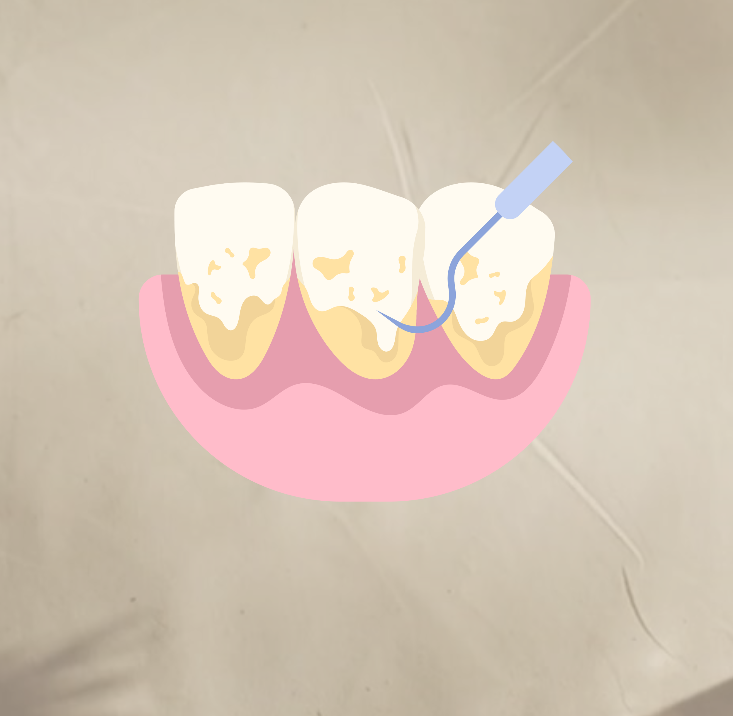 Teeth Cleaning-4.png