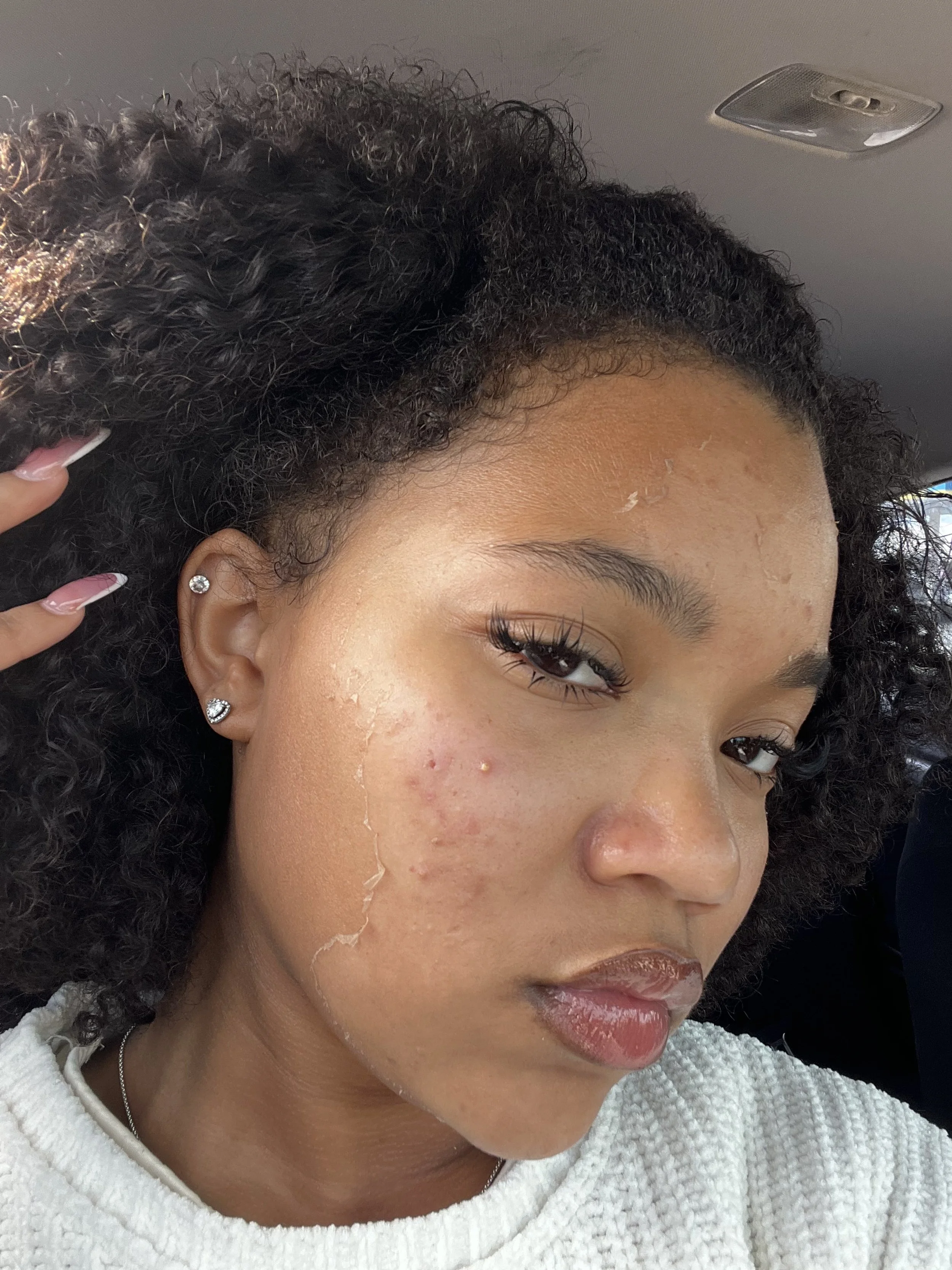 Houston Hyperpigmentation Fix: Why Chemical Peels Are a Game-Changer for Melanin-Rich Skin