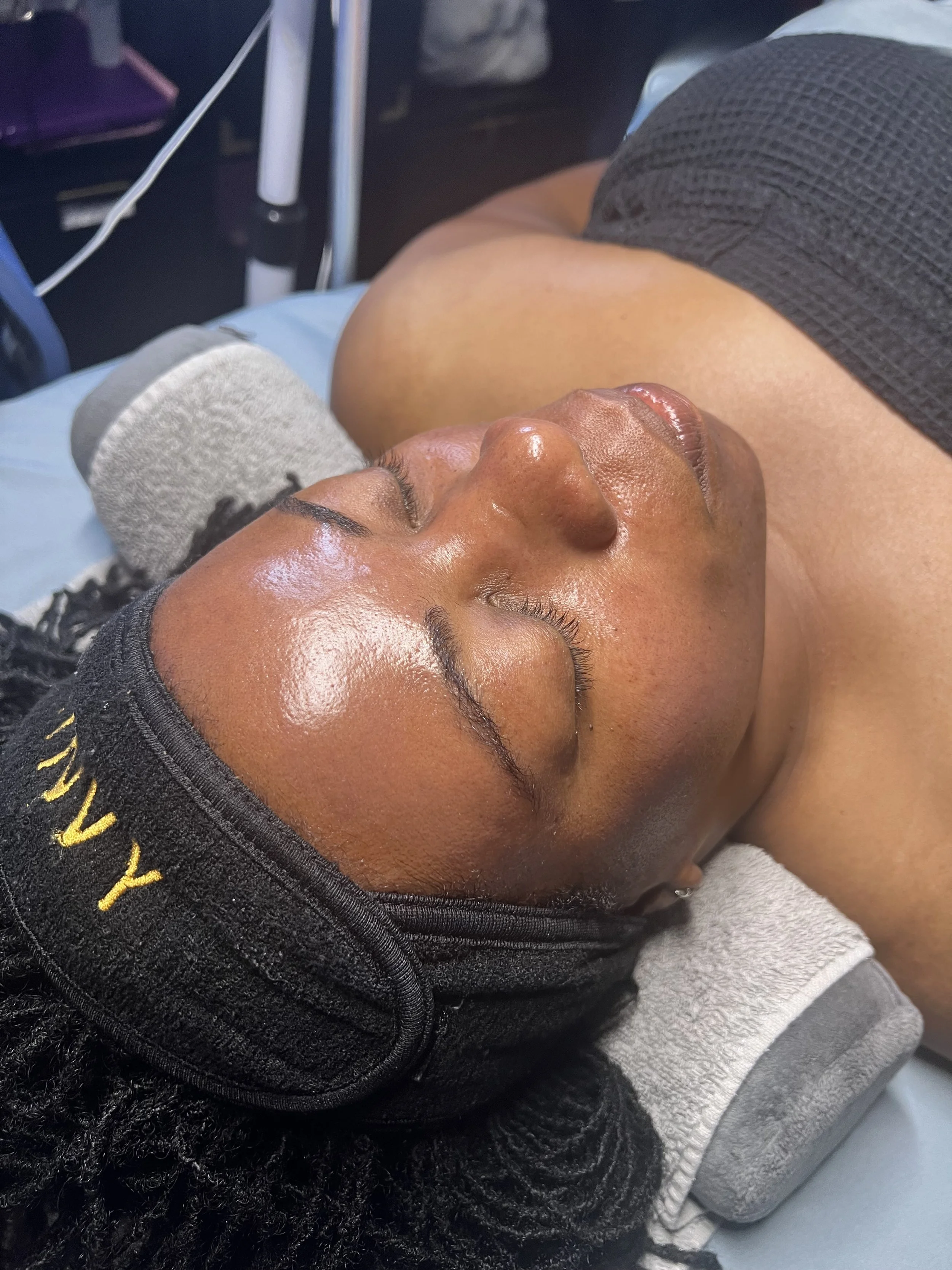 Microneedling for Dark Spots & Acne Scars in Houston: What Black Skin Needs to Know Before You Book
