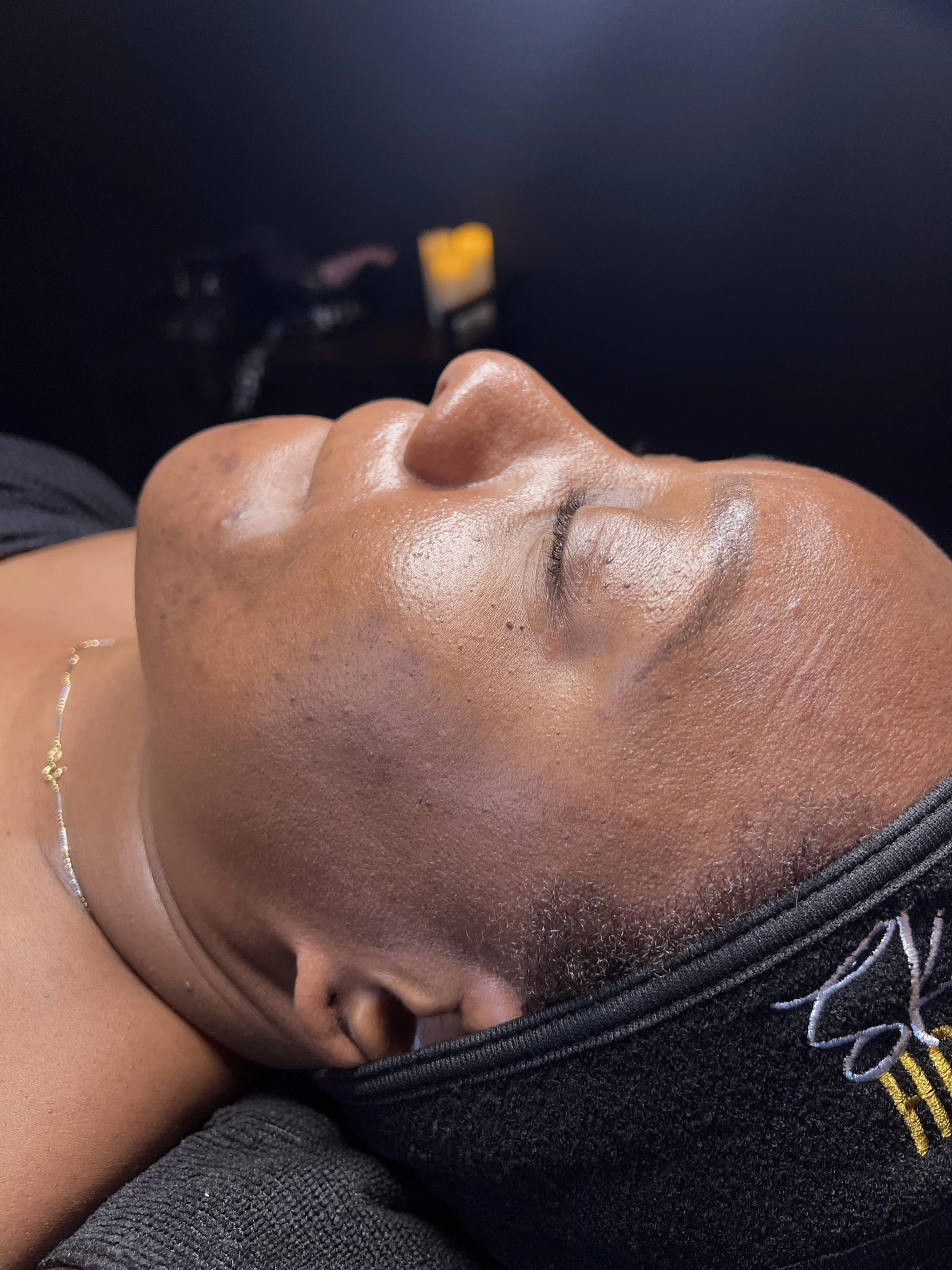 Epidermal vs Dermal Hyperpigmentation: Why It Matters