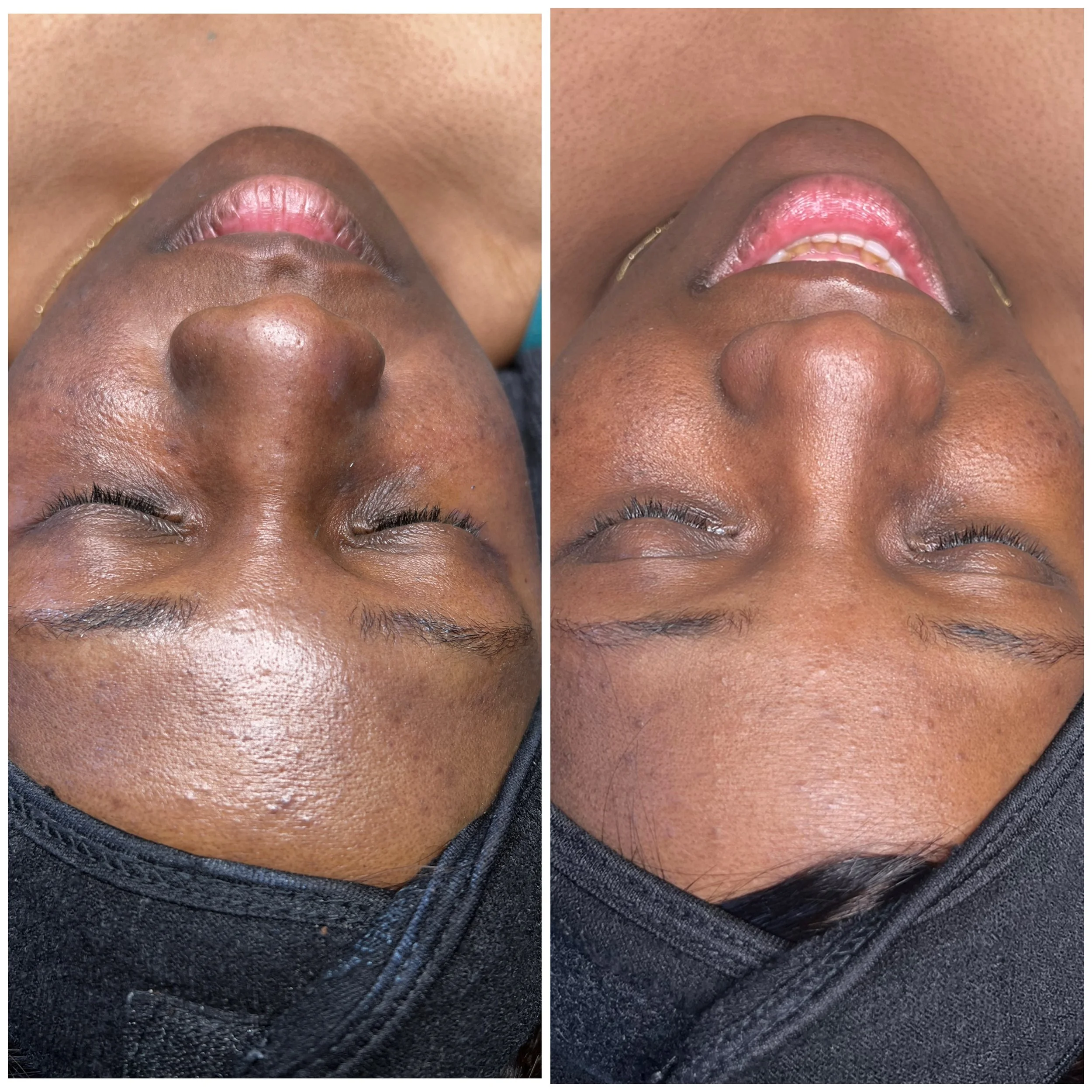 Comparison of a person's face before and after a skincare treatment, showing smoother skin and improved appearance.