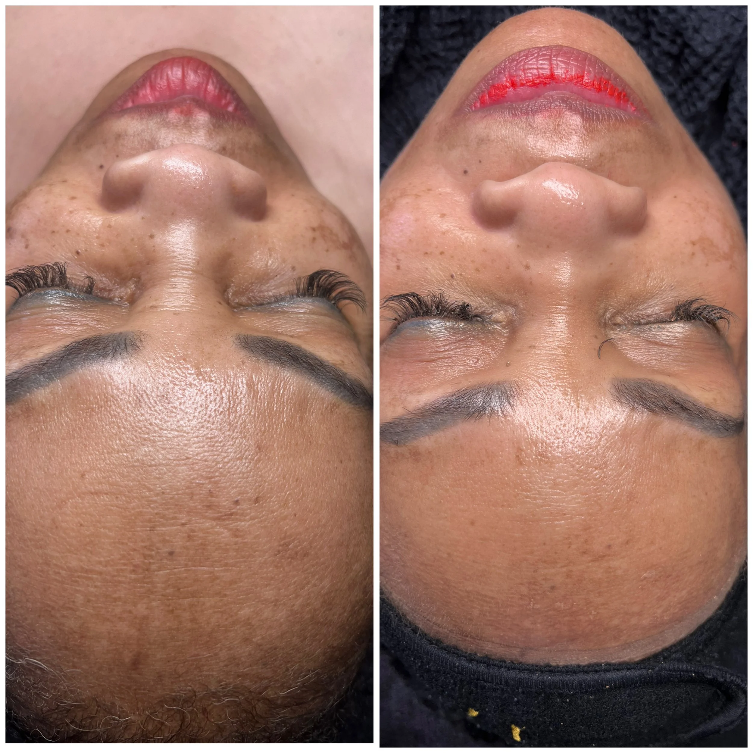 Comparison of a woman's face before and after a skincare treatment, focusing on forehead, nose, and cheek areas with visible improvements in skin texture and pigmentation.