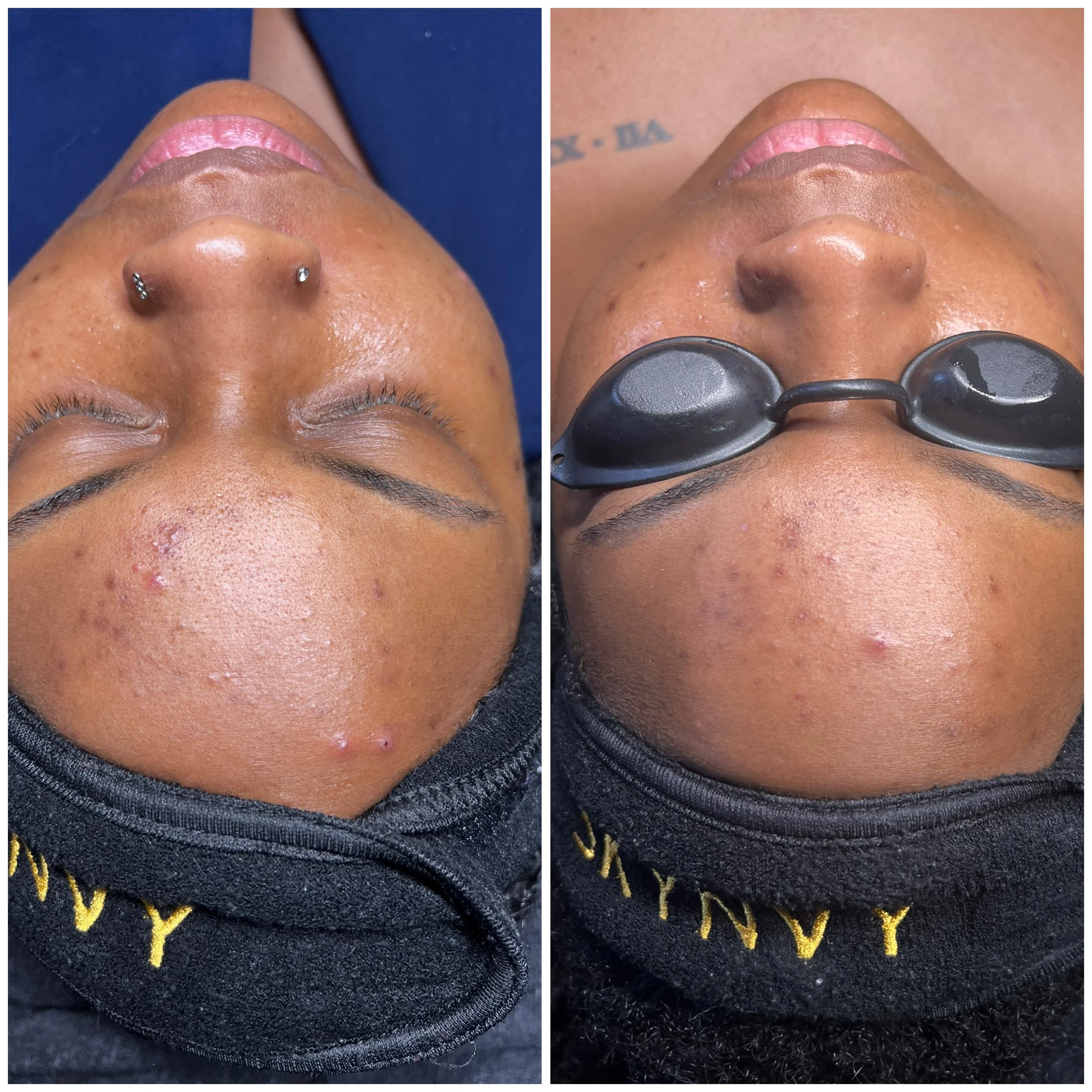 Side-by-side comparison of a person's face before and after skincare treatment. The person has a nose piercing and wears black protective glasses in the second image. The skin appears to have reduced acne and blemishes in the after photo.