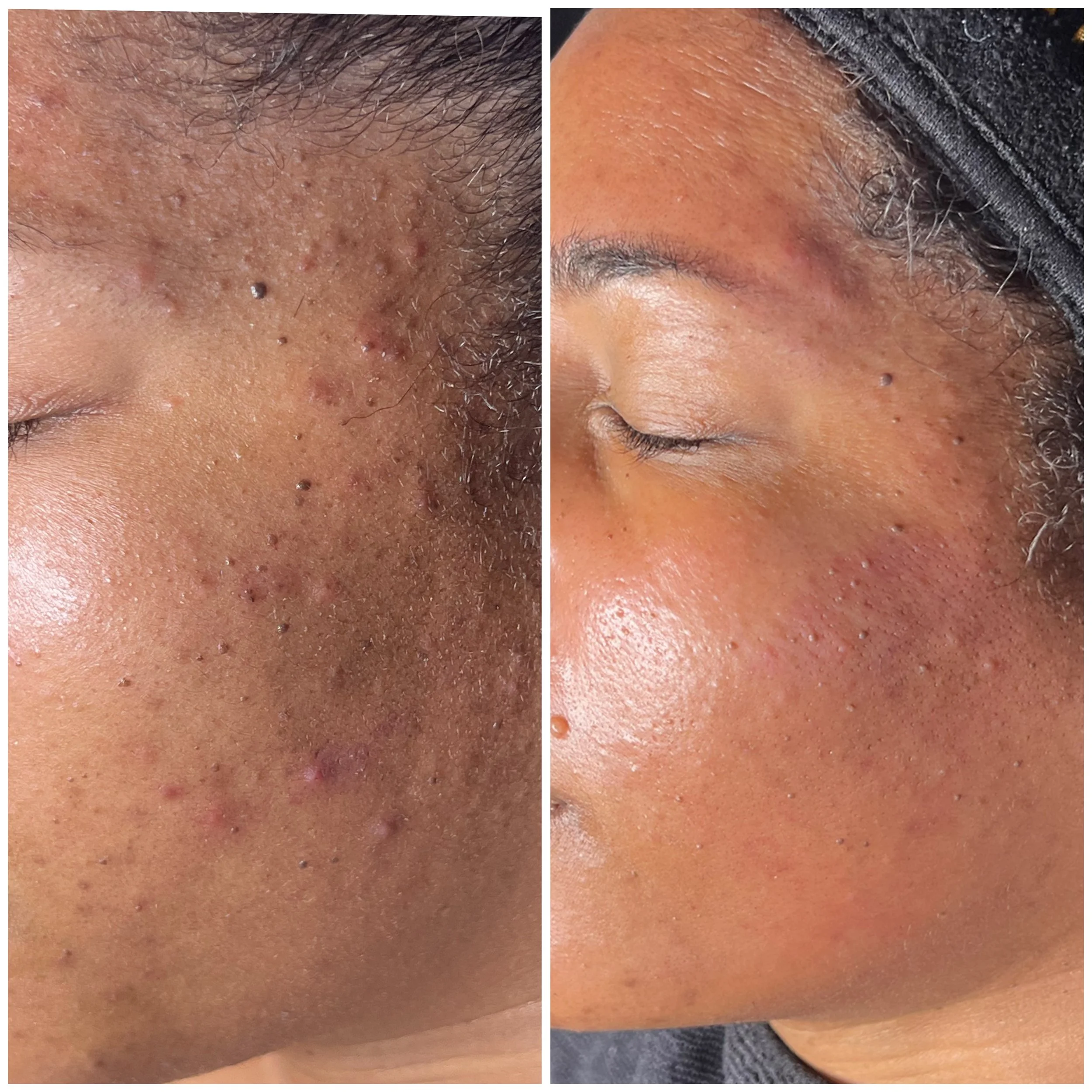 Side-by-side comparison of a person's cheek before and after skincare treatment showing improvement in skin condition, with clearer, smoother skin on the right.
