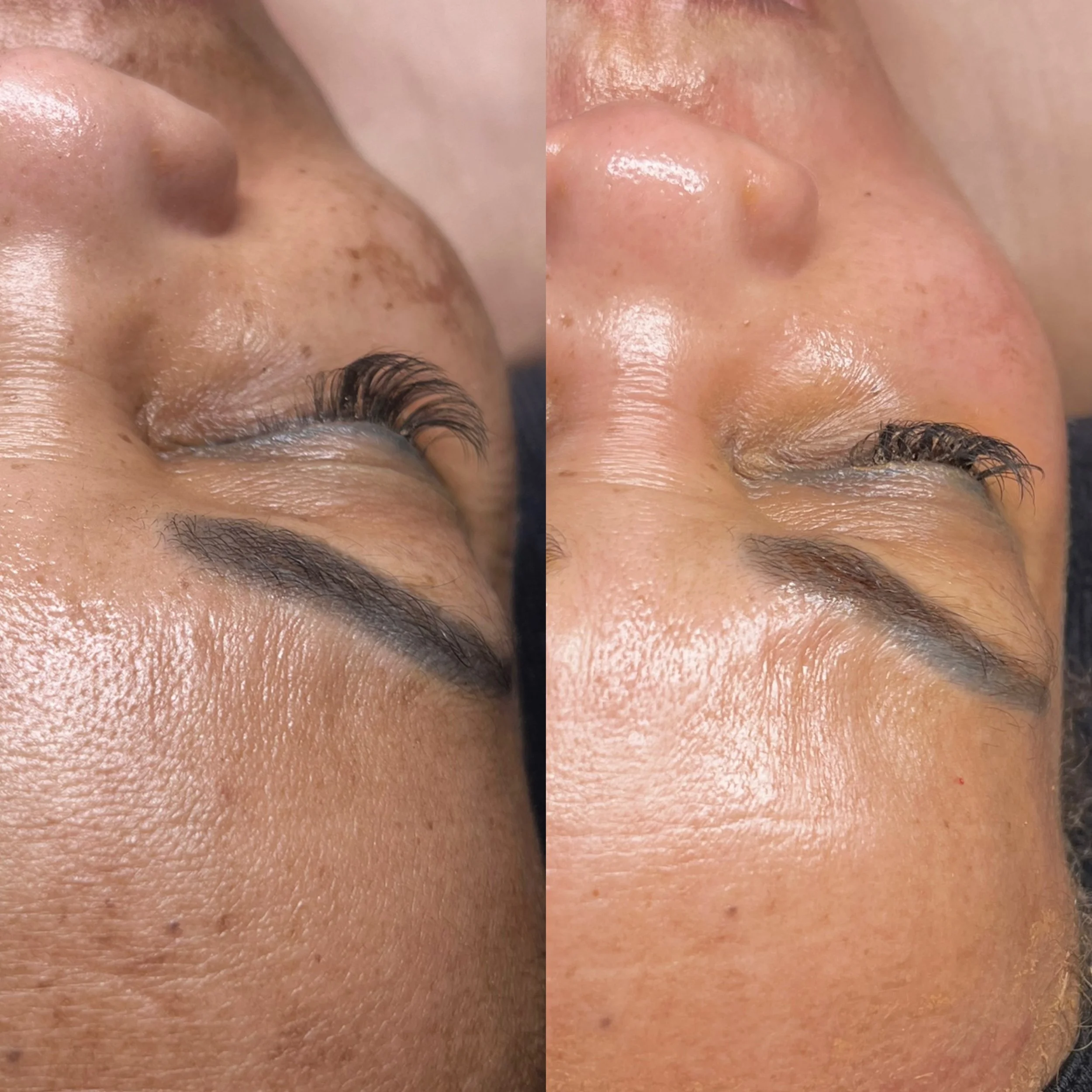 Comparison of a woman's face before and after a skincare treatment, focusing on forehead, nose, and cheek areas with visible improvements in skin texture and pigmentation.
