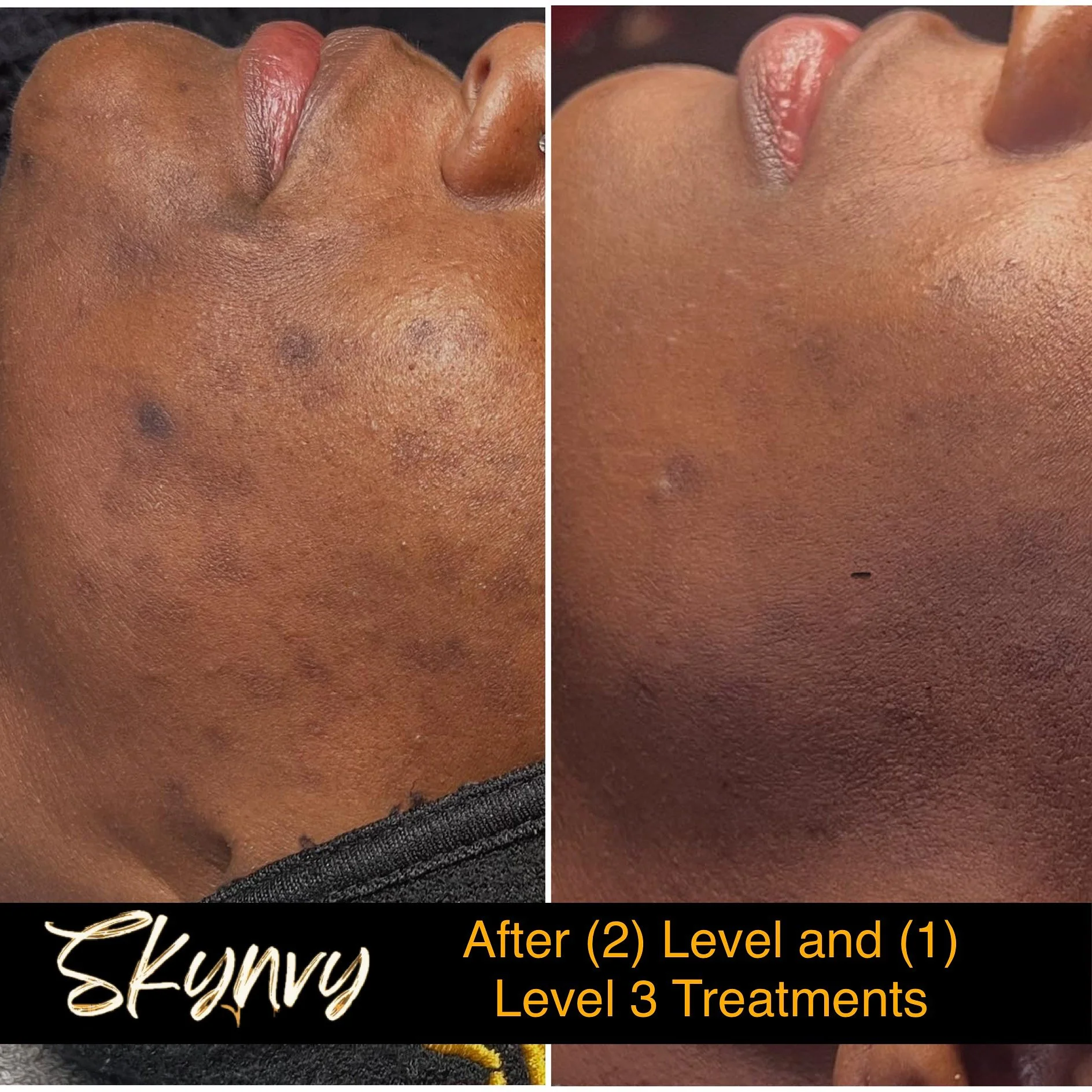 Side-by-side before and after close-up photos of a person's face showing skin clearing from dark spots and uneven texture after two Level and one Level 3 treatments, with a label indicating "SkyNvy" at the bottom.