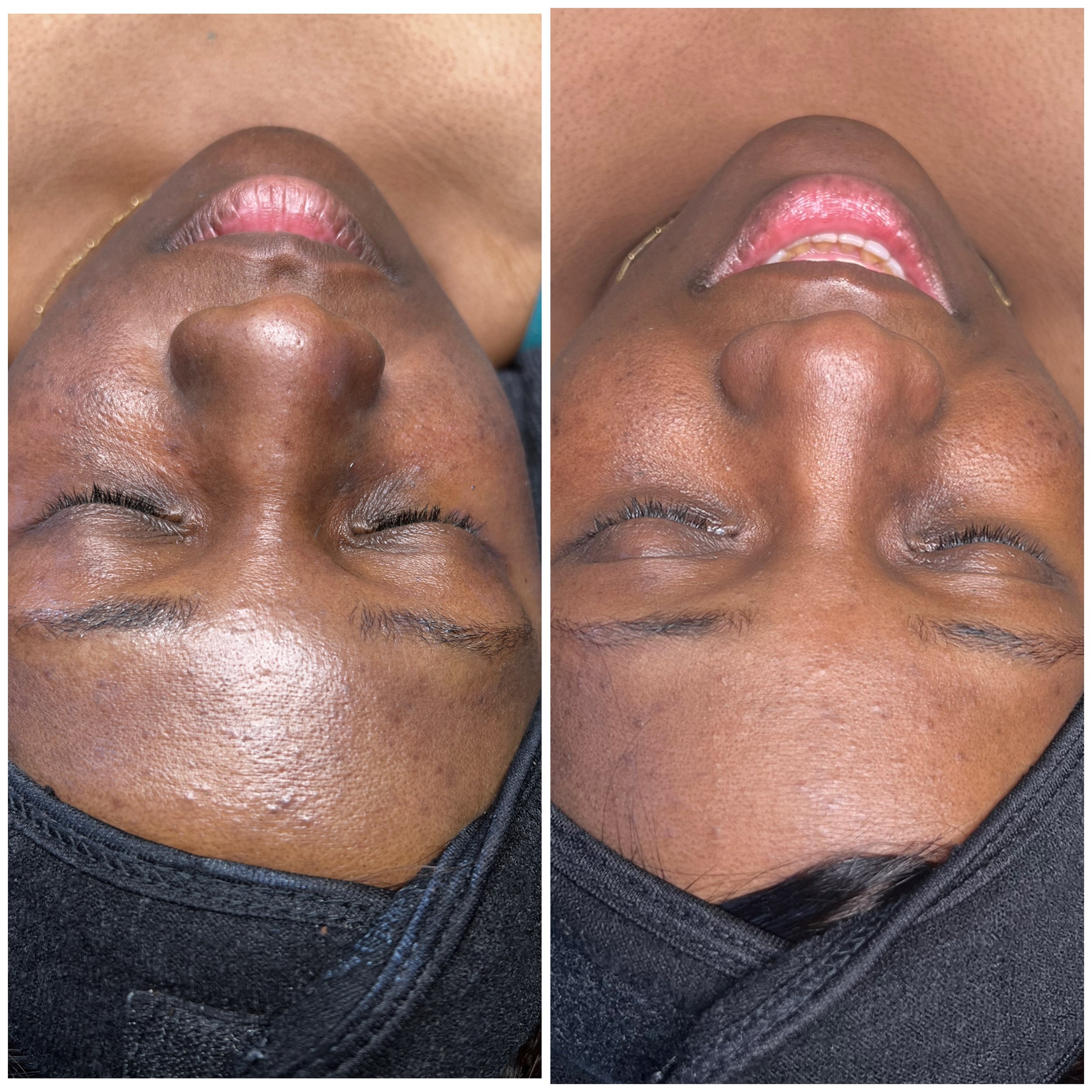 Close-up of a woman's face before and after facial treatment, showing improved skin texture and clarity.