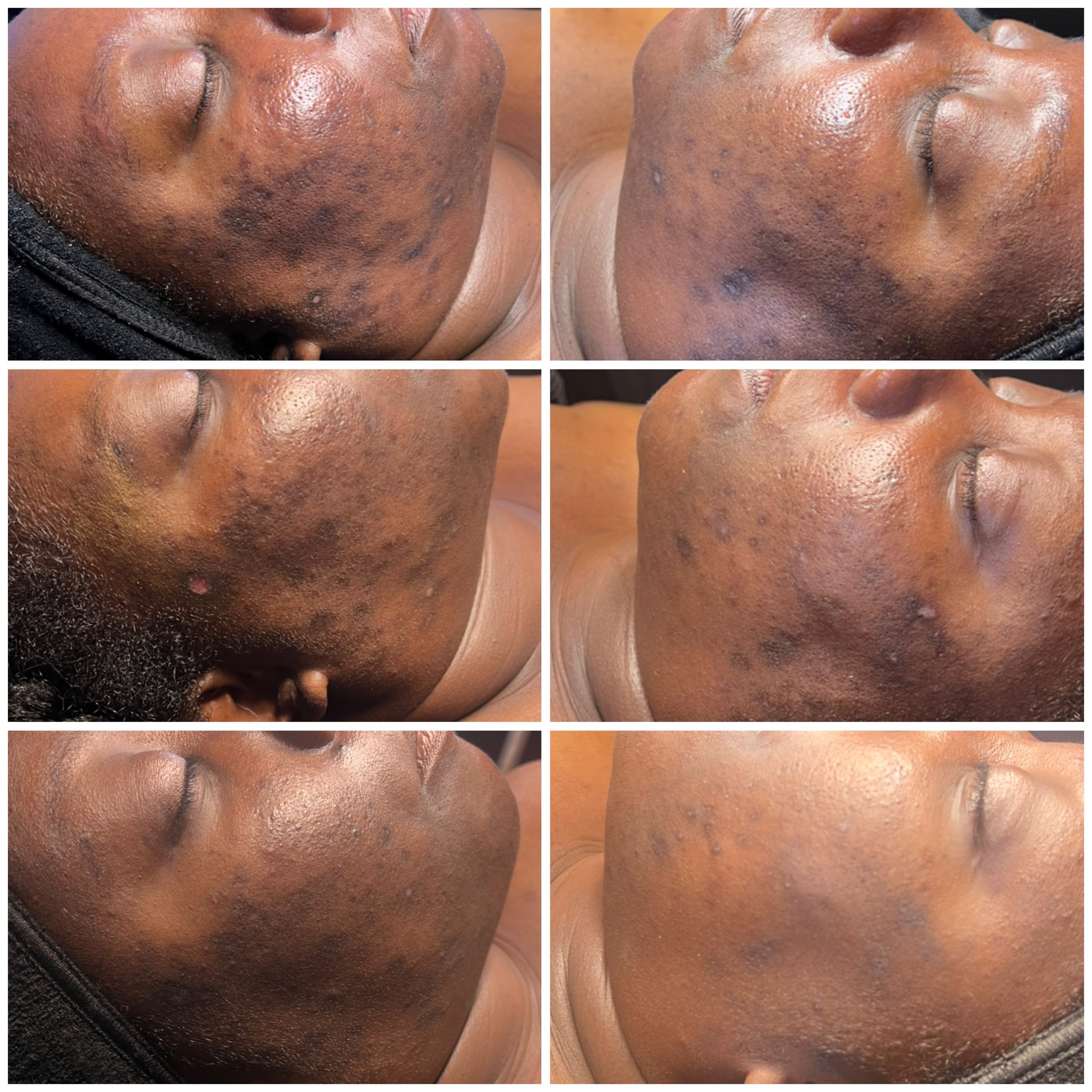 Series of six before and after close-up photos showing skin treatment results on a person's face, focusing on reduction of dark spots, hyperpigmentation, and acne scars.