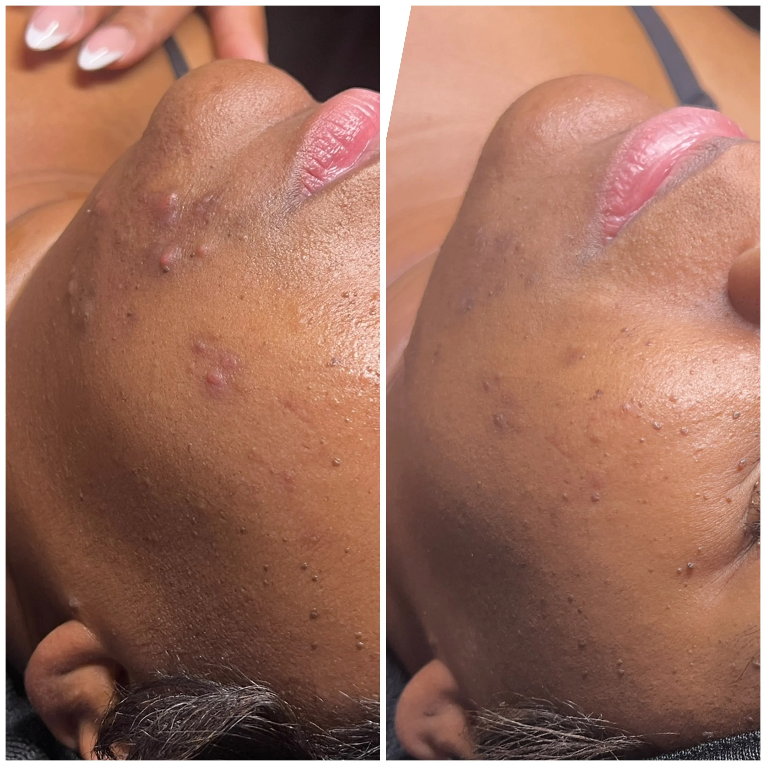 Close-up of a woman's face showing before and after skin treatment, with improved skin texture and reduced acne scars.