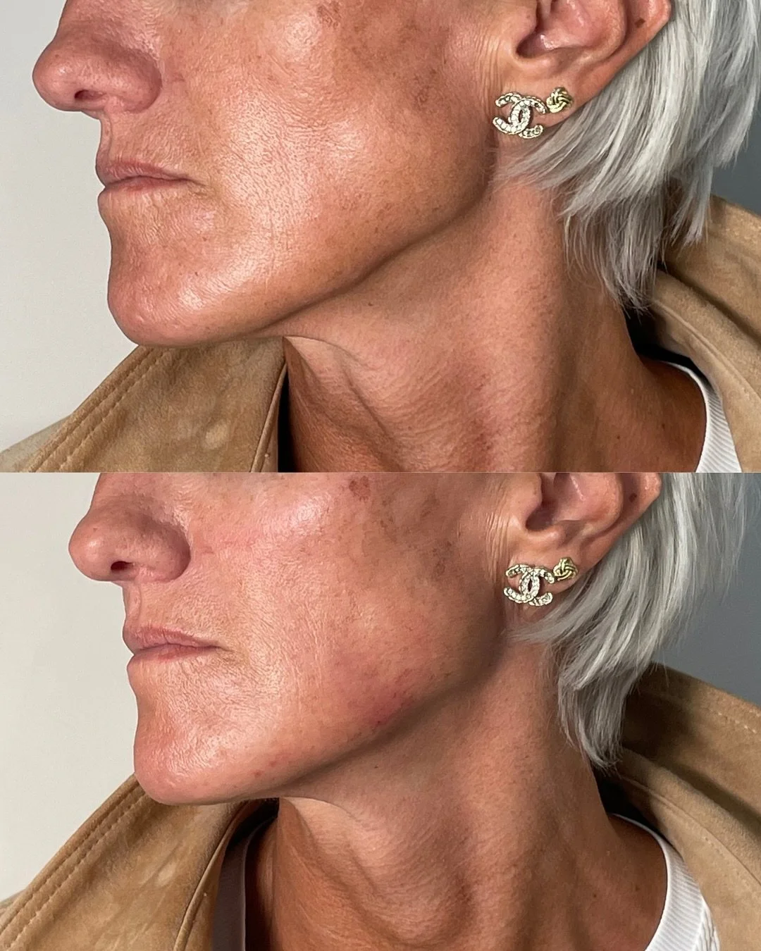 Before and after filler for jowls
