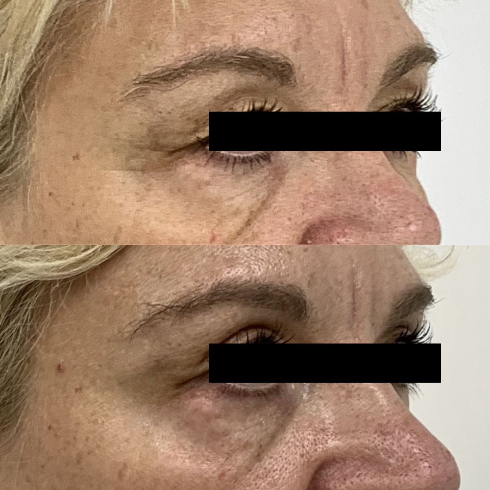 Before and after skin booster treatment around the eye area to improve crows feet and general skin quality