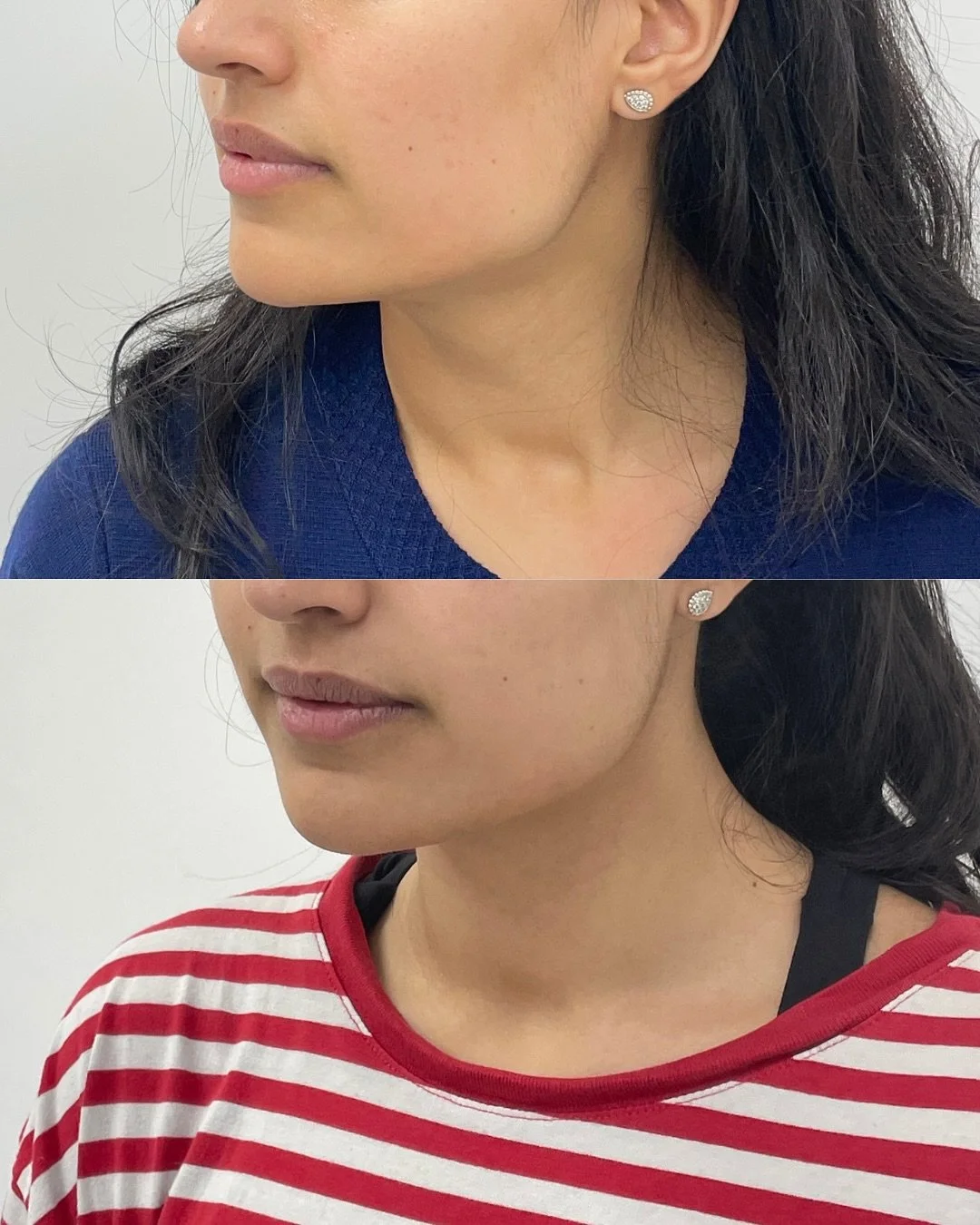Swipe to see this amazing transformation 👉

This treatment targets the masseter muscles to:
✨ create a softer, more contoured jawline
✨ reduce jaw tension and clenching
✨ enhance facial balance naturally

Results appear gradually over a few weeks, l