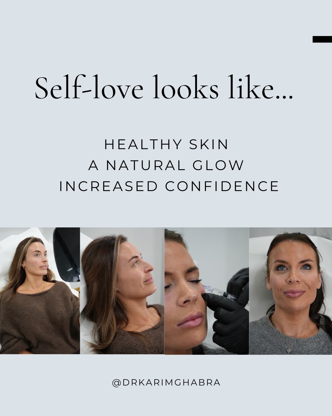 Show your skin some love this Valentine&rsquo;s Day 🤍

When you take care of your skin and rejuvenate it from within, your natural glow shines through ✨

Aesthetic skin-boosting treatments, such as polynucleotides and Profhilo, show their full resul