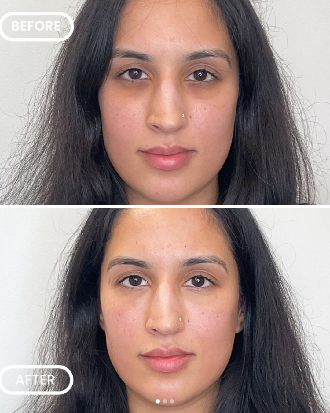 Before and after tear trough filler 