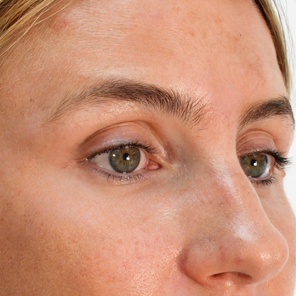 Close up of patients eye area showing smoothed out wrinkles and fine lines from Botox treatment