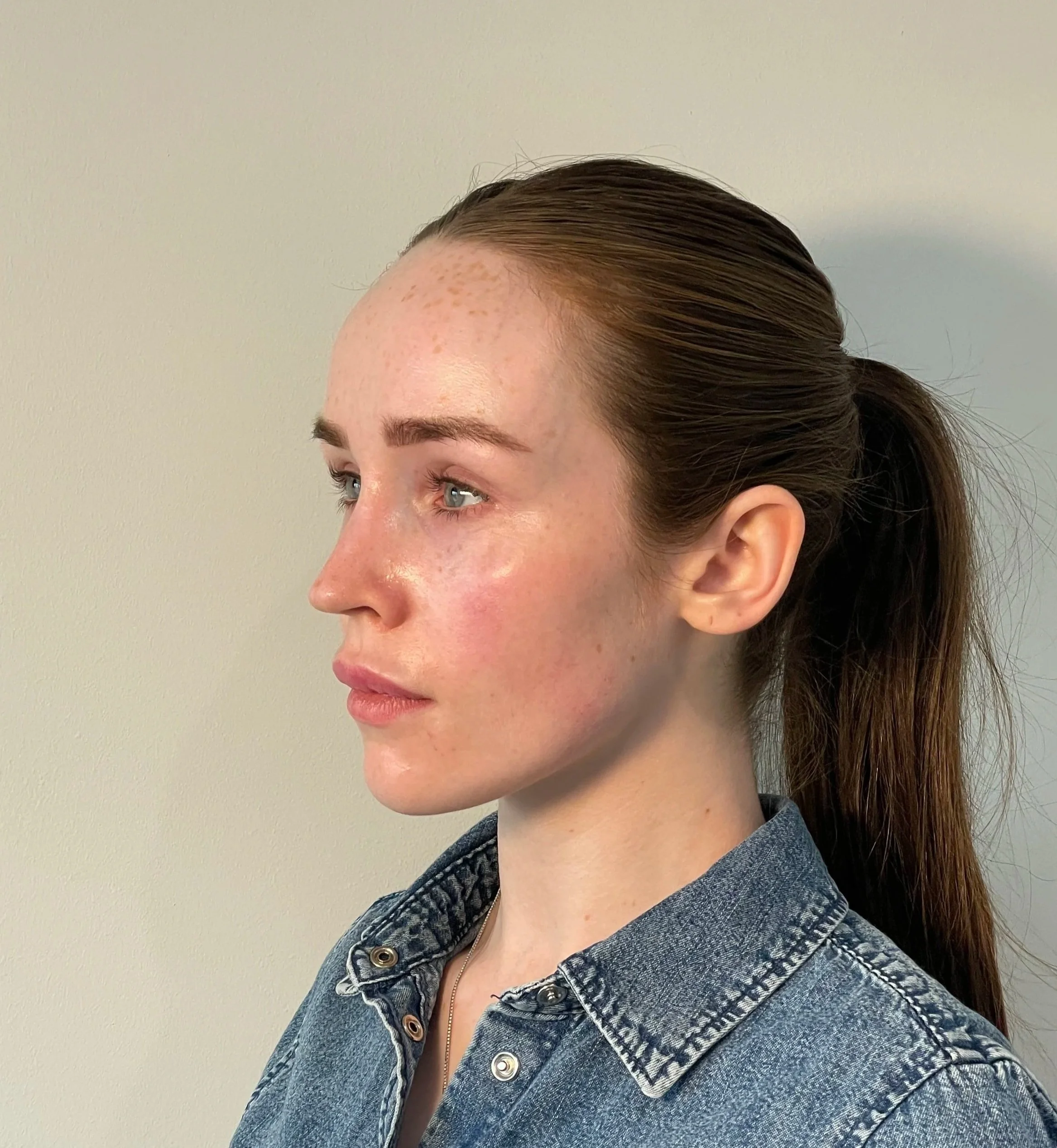 Dermal Fillers Explained: What Patients Should Know Before Treatment