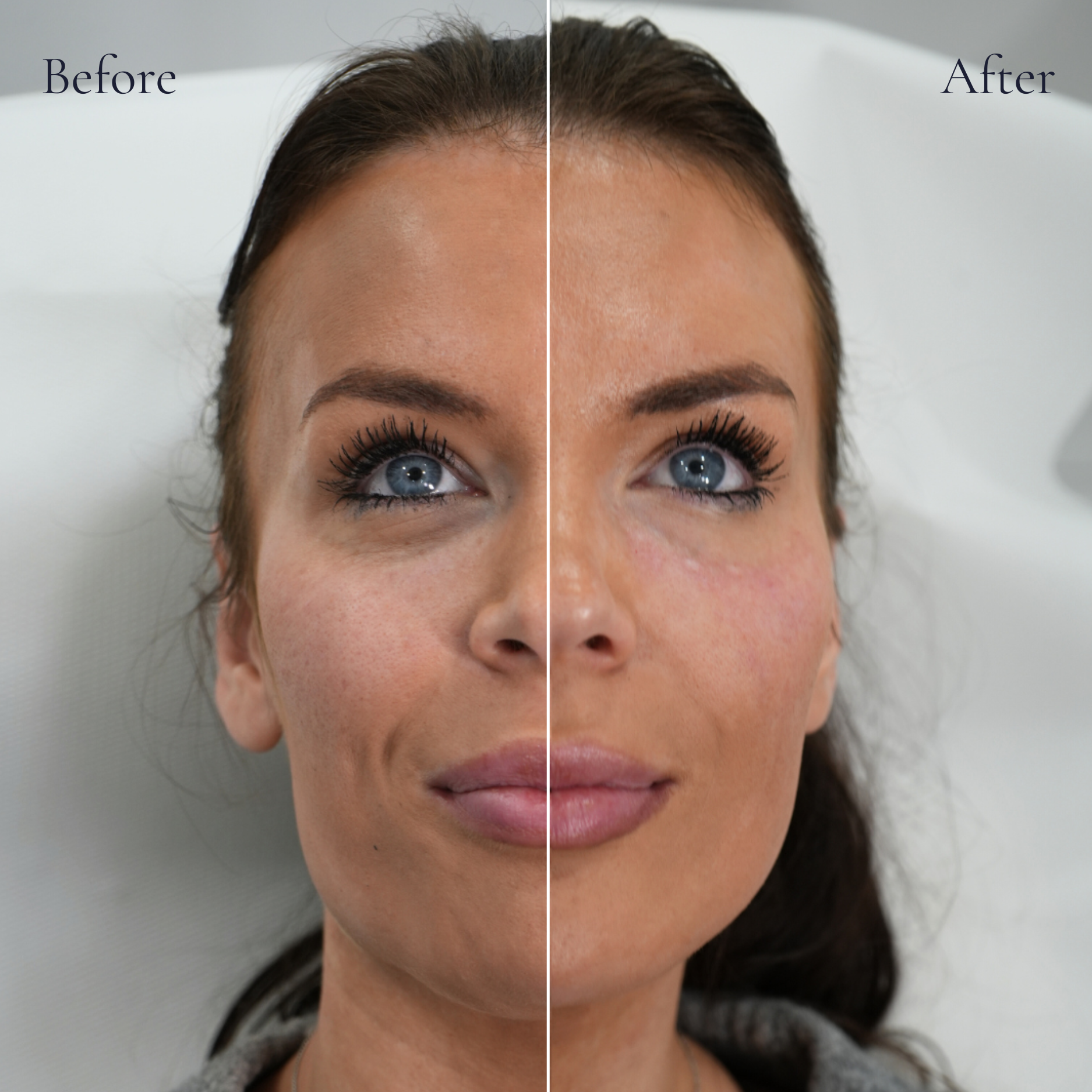 Before and after under eye polynucleotides