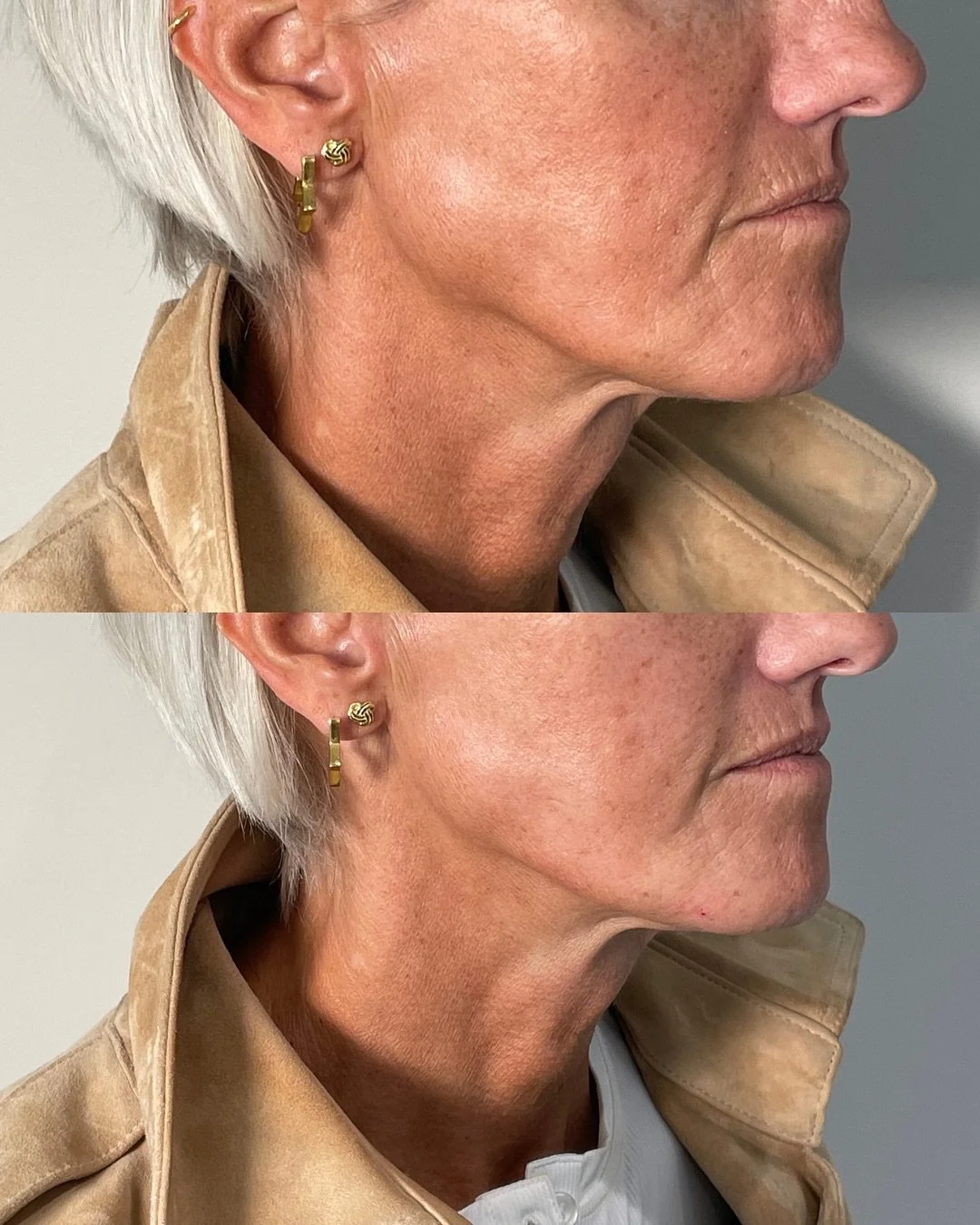 Before and after filler for jowls