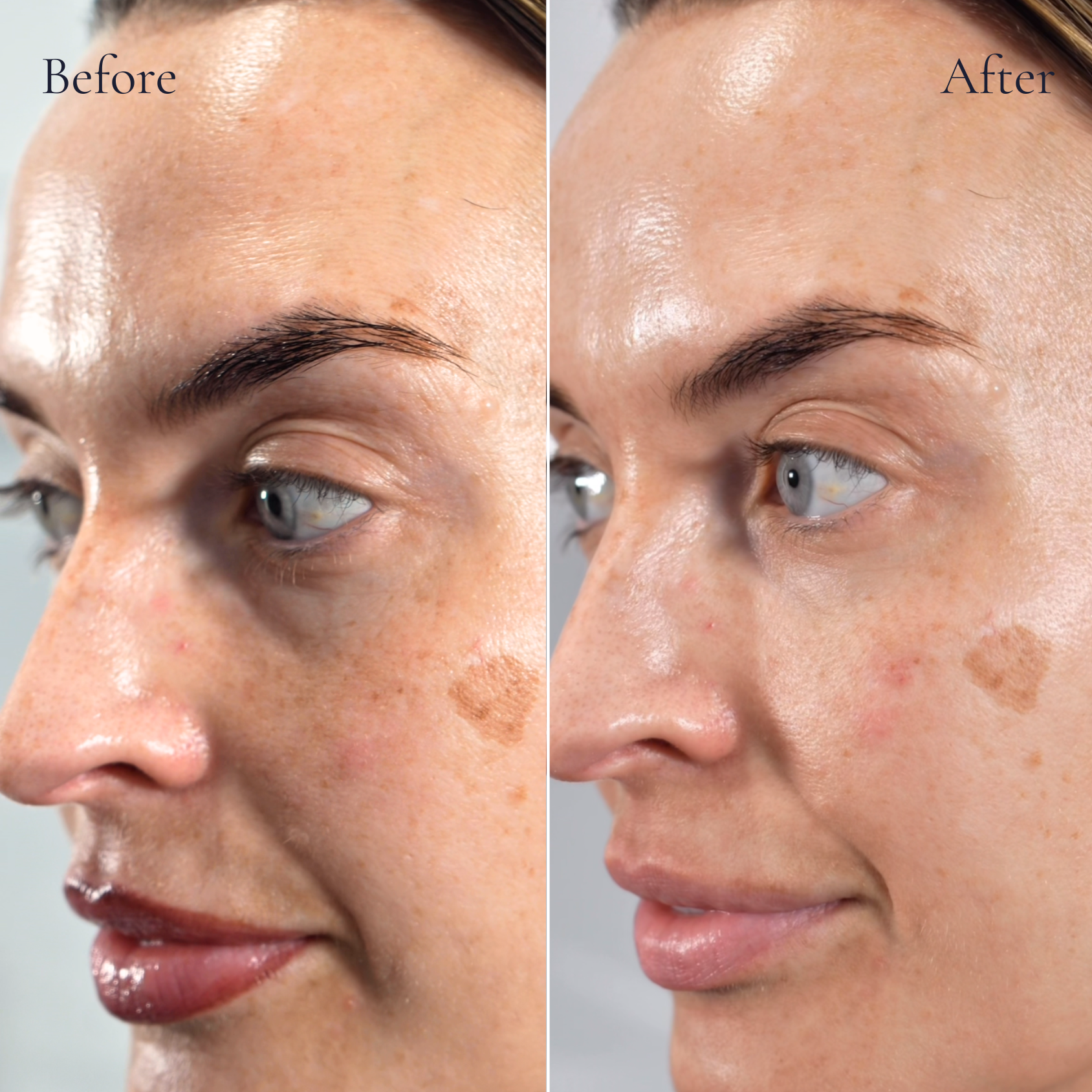 Before and after under eye filler