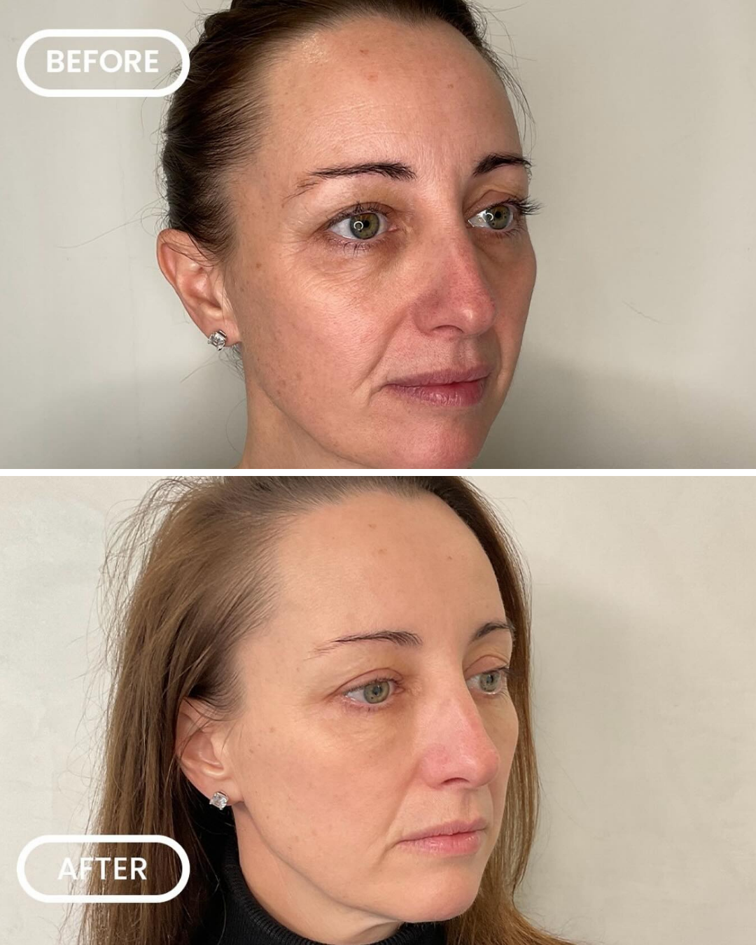Before and after tear trough filler 