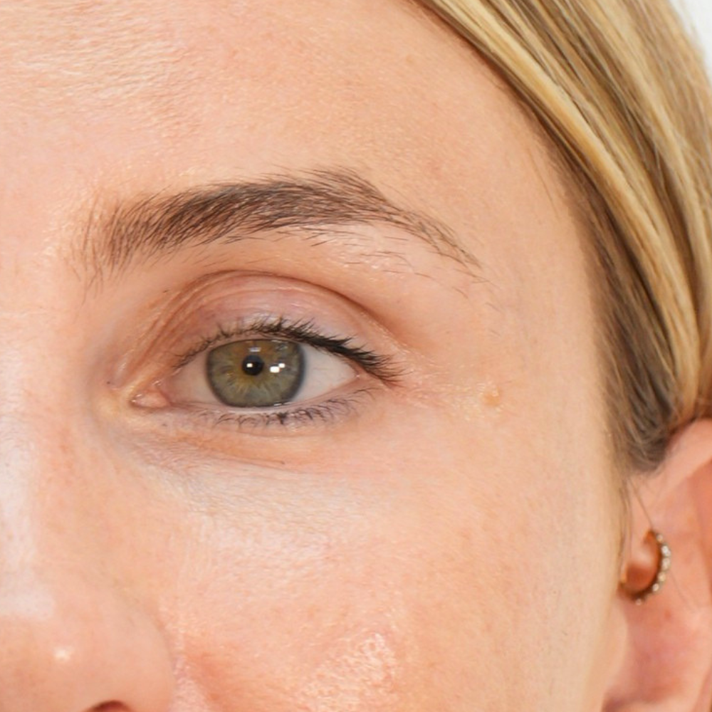 Dr Karim's patient, Sophie after Botox treatment for crows feet and wrinkles around the eyes