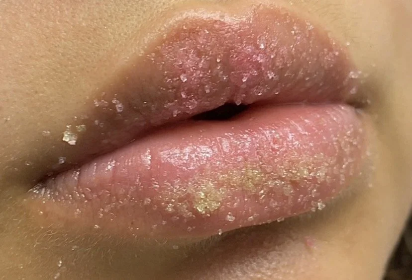Close-up of lips with dry, chapped skin and flakes.