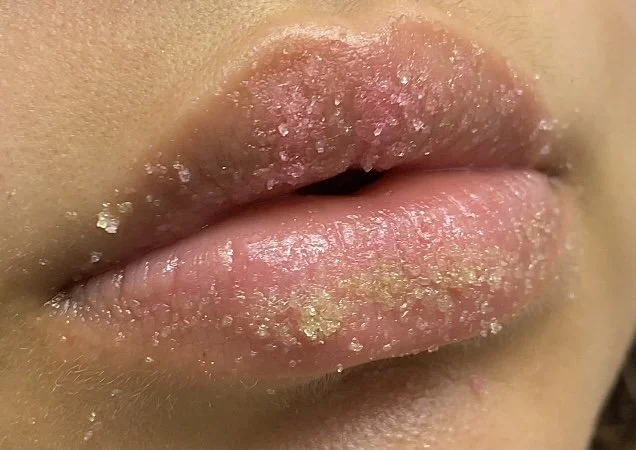 Close-up of lips with dry, chapped skin and flaky, peeling patches.