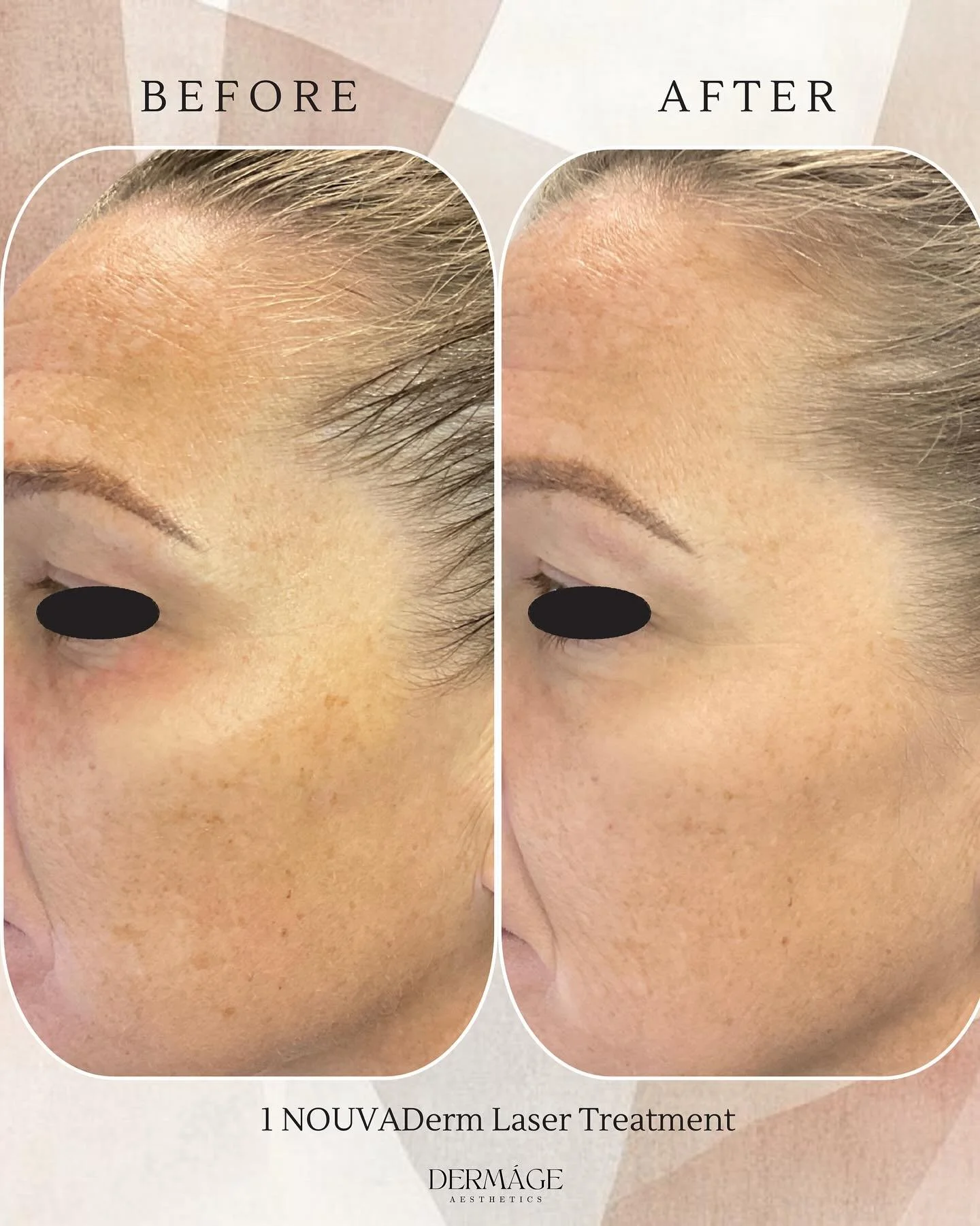 Transformation Tuesday ✨

Our patient's transformation after just one NOUVADerm laser treatment is a must-see!

This advanced fractional laser tackles fine lines, wrinkles, enlarged pores, scars, stretch marks, hyperpigmentation, and sun spots. 

Bes