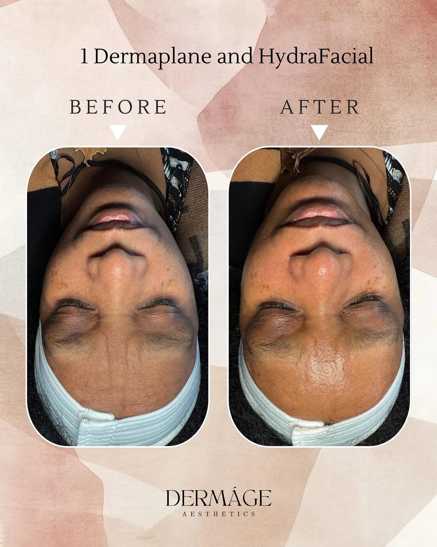 Glowing into the weekend! ✨ 

📆 Link in Bio

☎️: (360) 323-7476

#dermageaesthetics #esthetician #hydrafacial #dermaplane #healthyskin #skinofcolor #vancouverwa