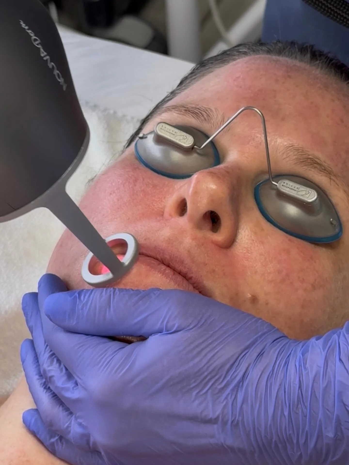 Glow differently ✨

At Derm&aacute;ge Aesthetics | Vancouver, Washington, one of our most-loved technologies is the NOUVADerm &mdash; and for good reason.

This advanced skin resurfacing device is designed to gently yet effectively rejuvenate the ski