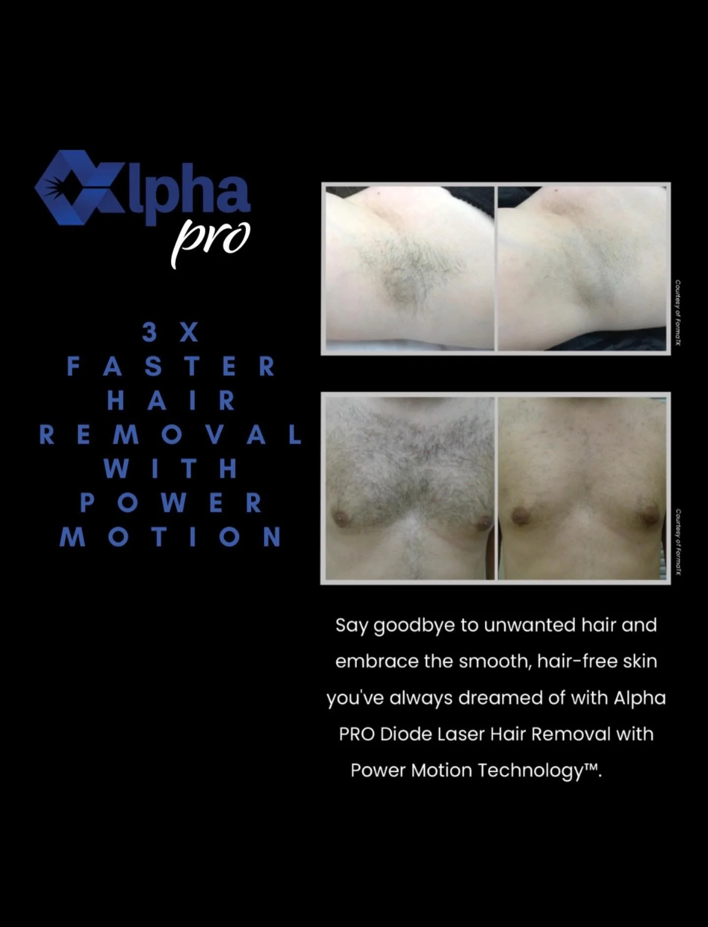 Smooth skin isn&rsquo;t just a luxury&mdash;it&rsquo;s confidence, convenience, and freedom. ✨

At Derm&aacute;ge Aesthetics, we&rsquo;re proud to offer advanced laser hair removal powered by the Alpha Pro diode system&mdash;designed to deliver faste