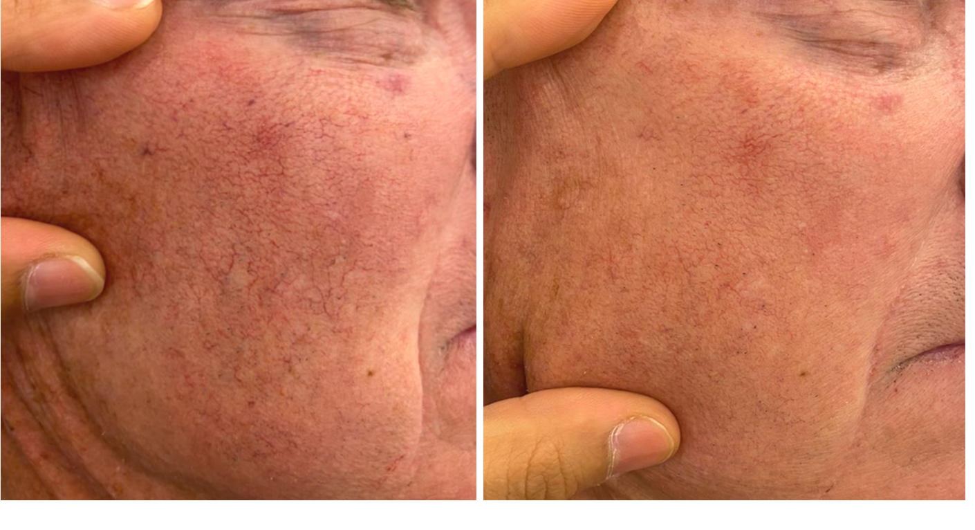 diffuse redness & vein.png