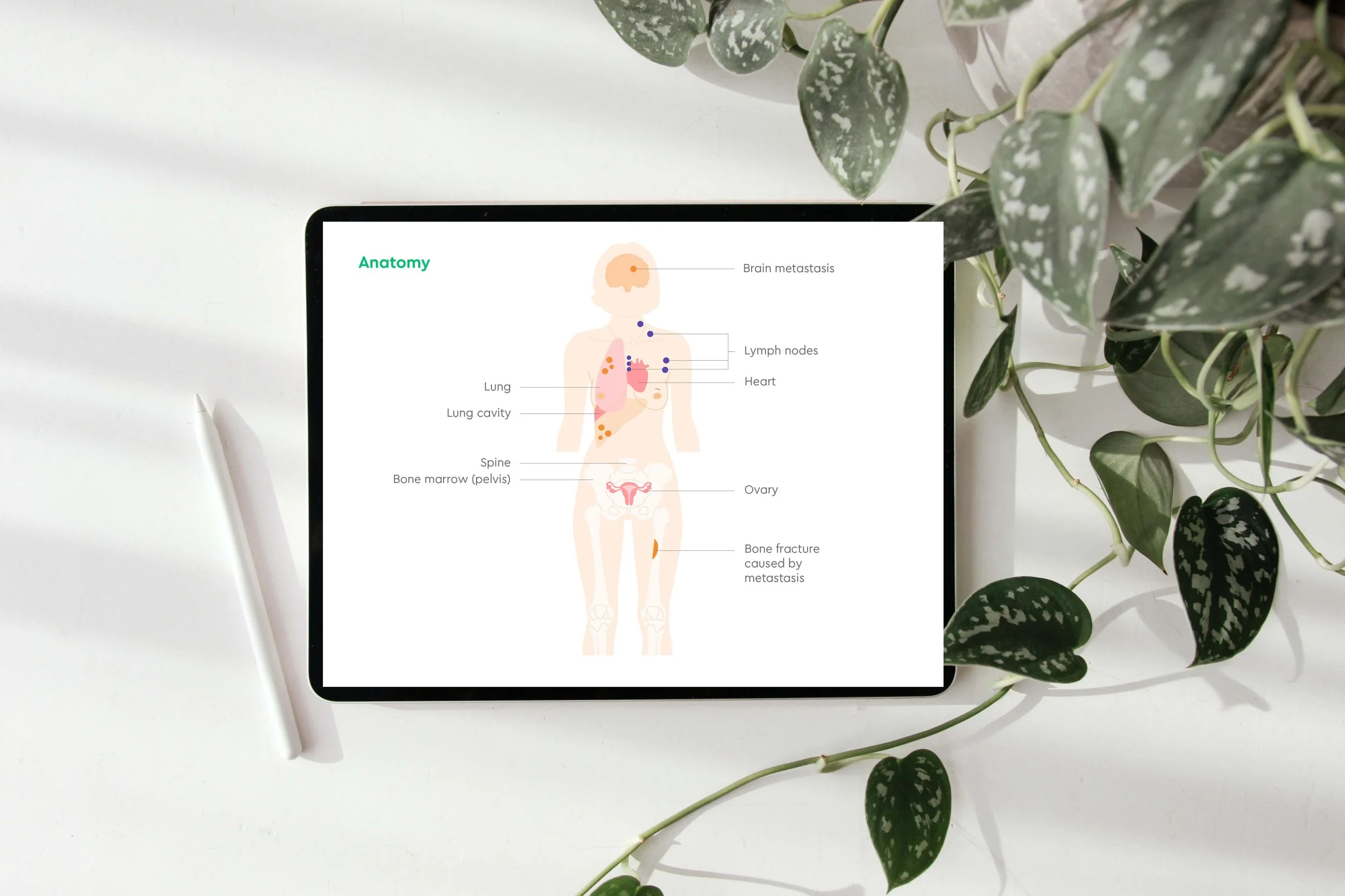 Digital illustration showing human anatomy with labeled organs and symptoms, including brain metastasis, lymph nodes, lung, heart, spine, ovary, and bone fracture caused by metastasis.