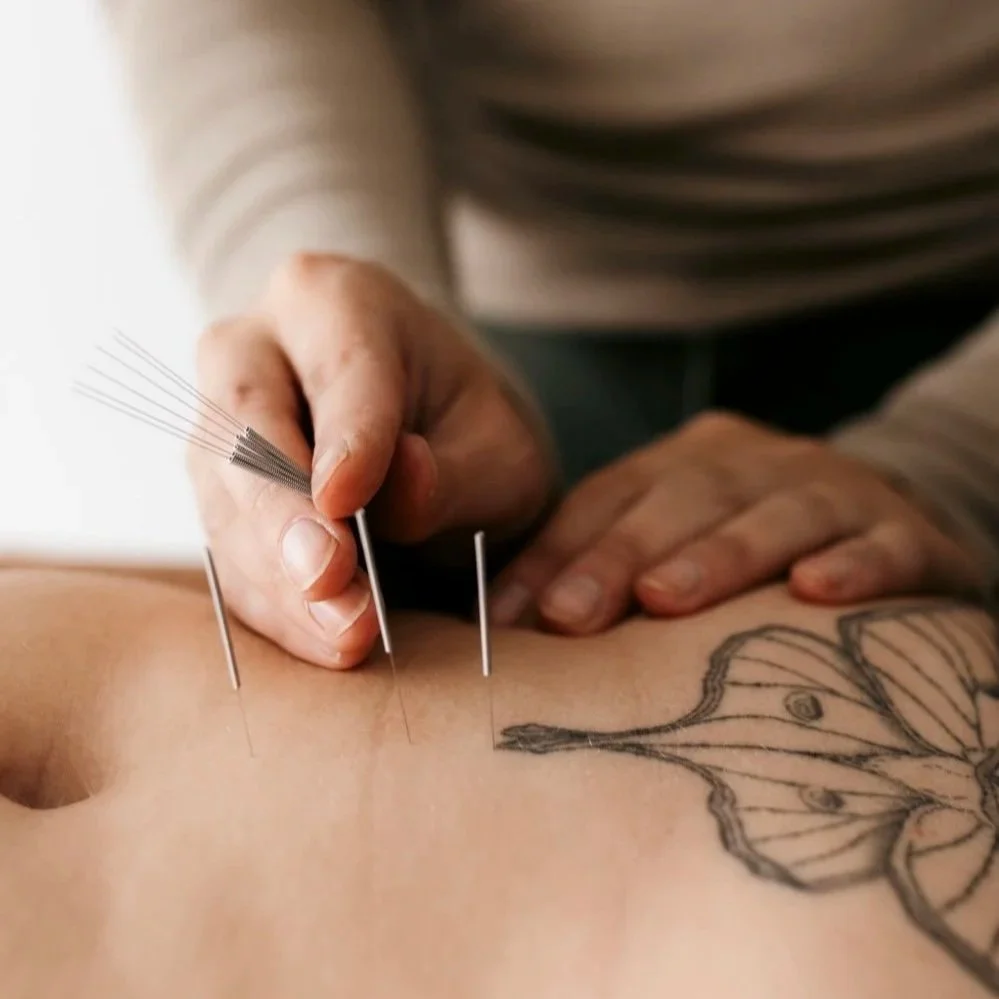 A person performing acupuncture by inserting thin needles into a person's skin with a tattoo of a butterfly on their side.