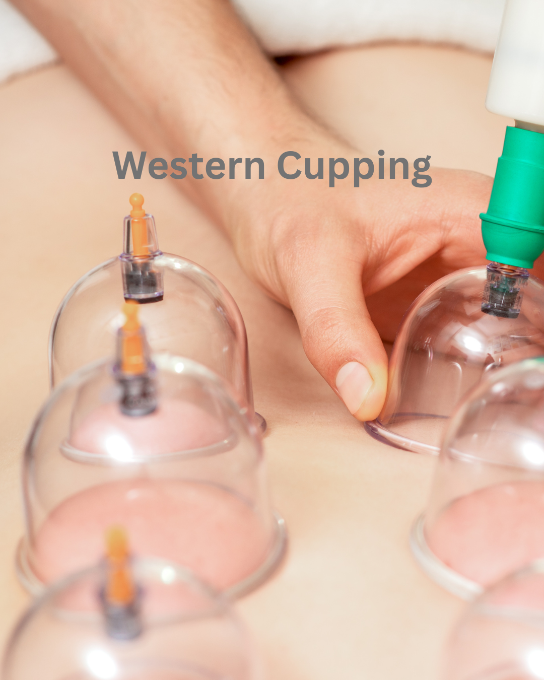 Western Cupping 1 day course £250