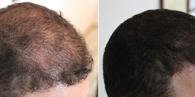 Before and after using growth factors