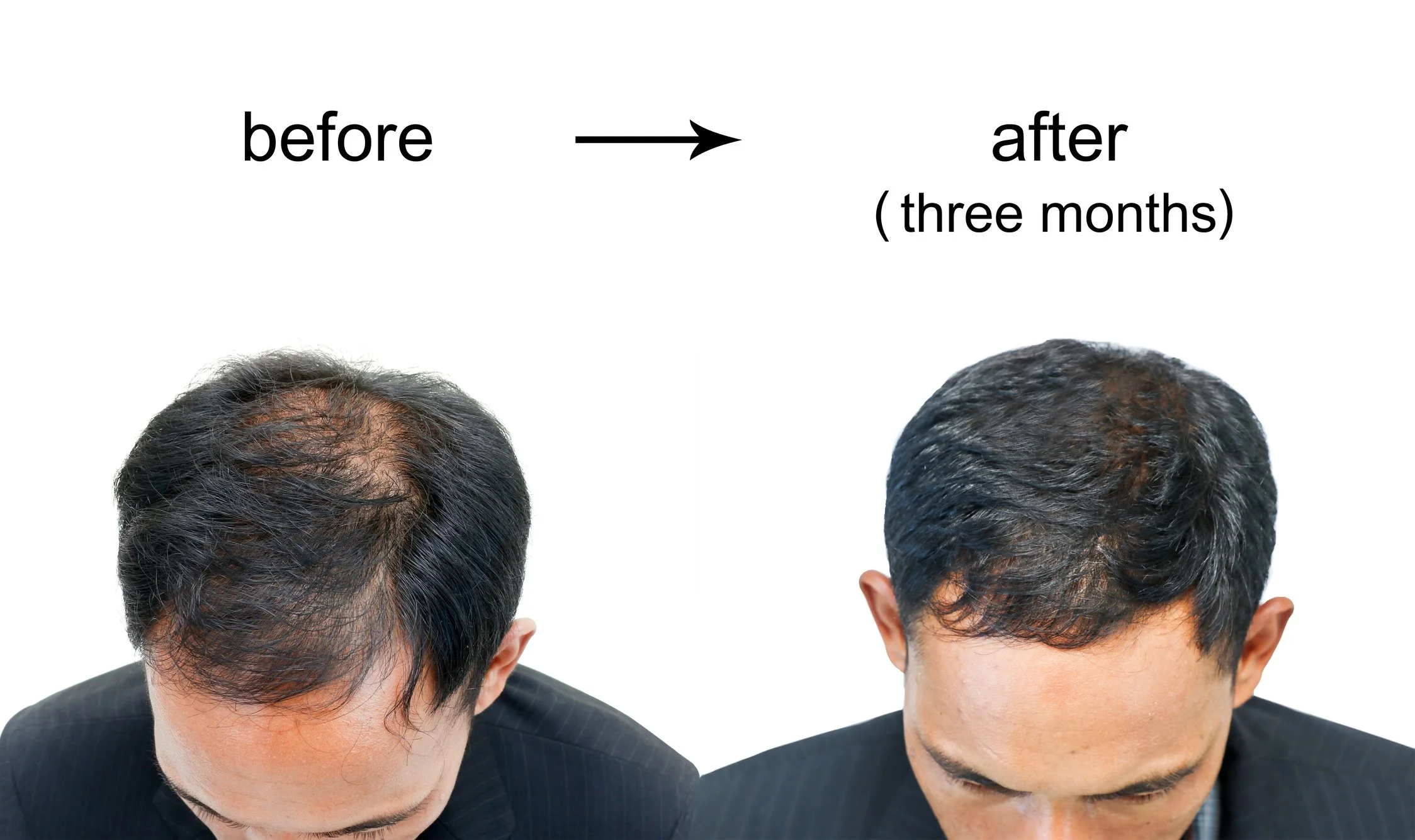 Showing male before and after 3 months of treatment