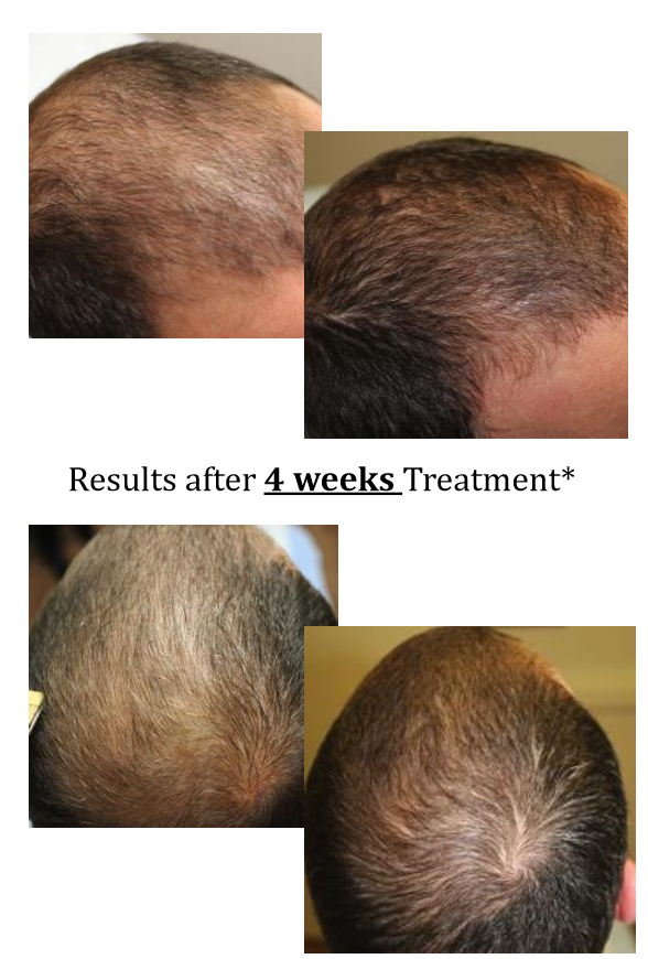 Comparison of before and after images showing hair growth on a person's scalp, with notable improvement after 4 weeks of treatment.
