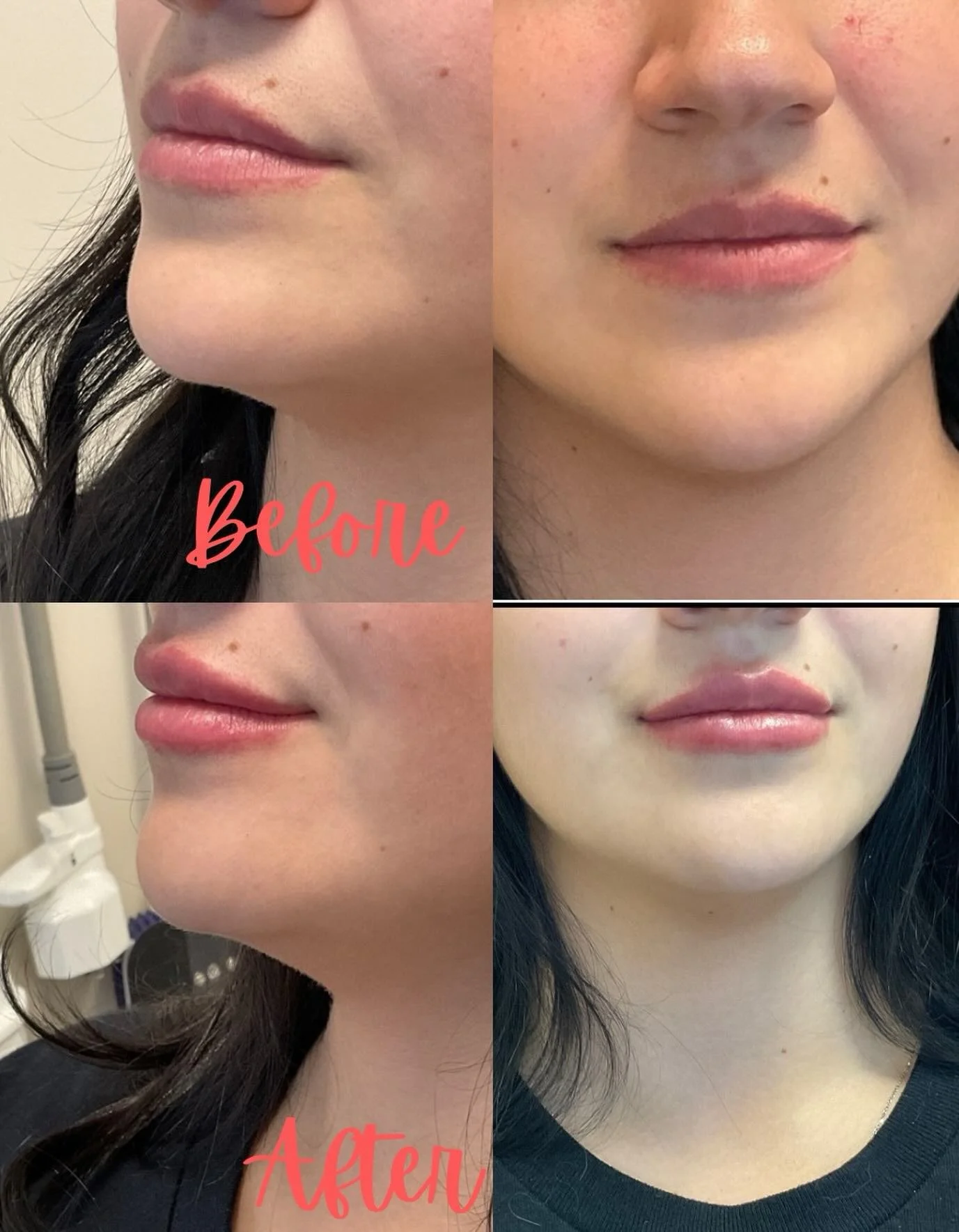 Yummy lips for Thanksgiving!🦃💋 #volbella #allergan #prettylips #bestaestheticinjectors #happythanksgiving