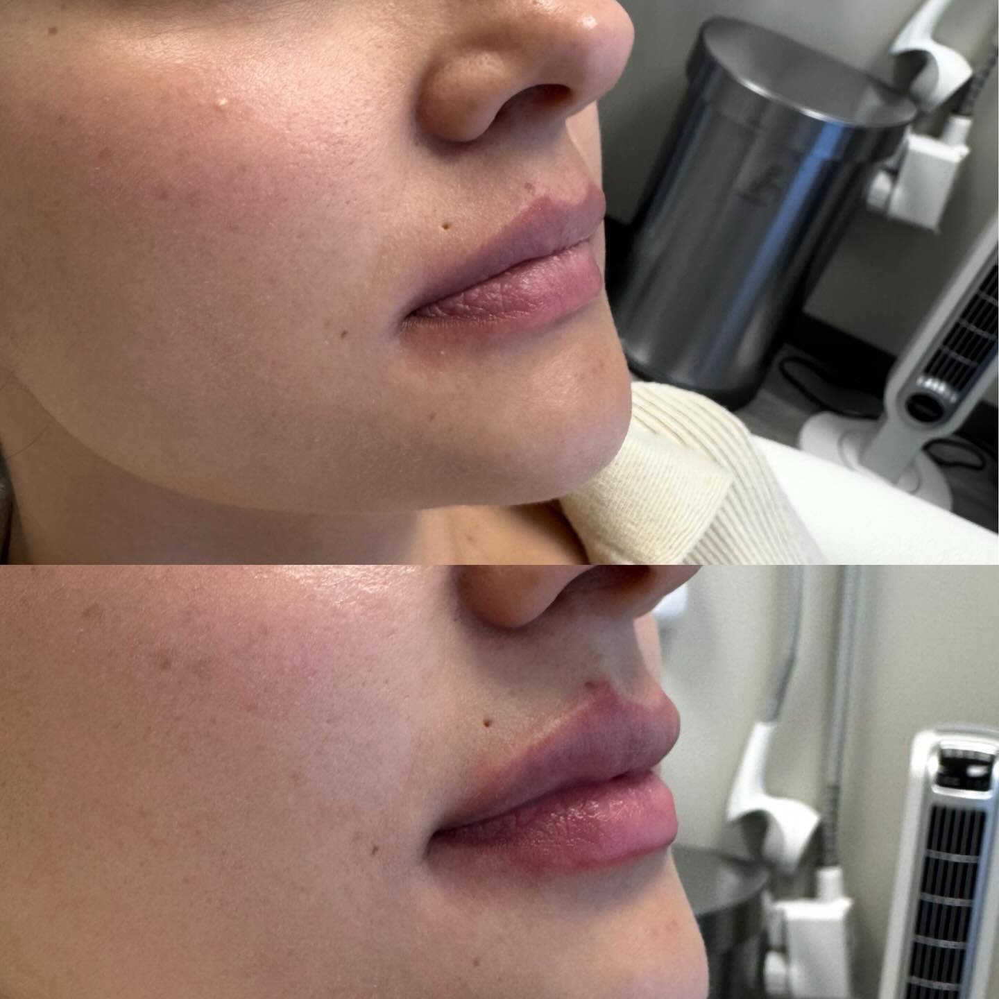 You better not pout? 👄💋 #bestaestheticinjectors #juvederm #allergan #poutylips